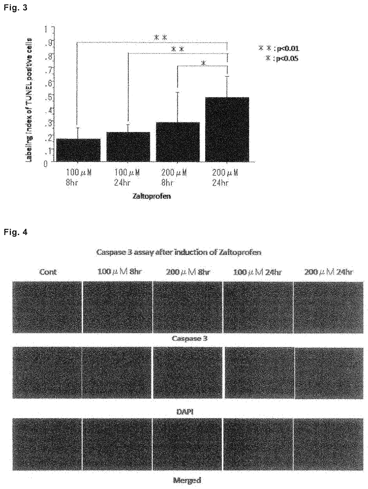 Drug for preventing, treating or preventing metastasis of giant cell tumor that occurs in bone or soft parts, chondrosarcoma, or osteosarcoma, local injection for arterial embolization, and artificial bone