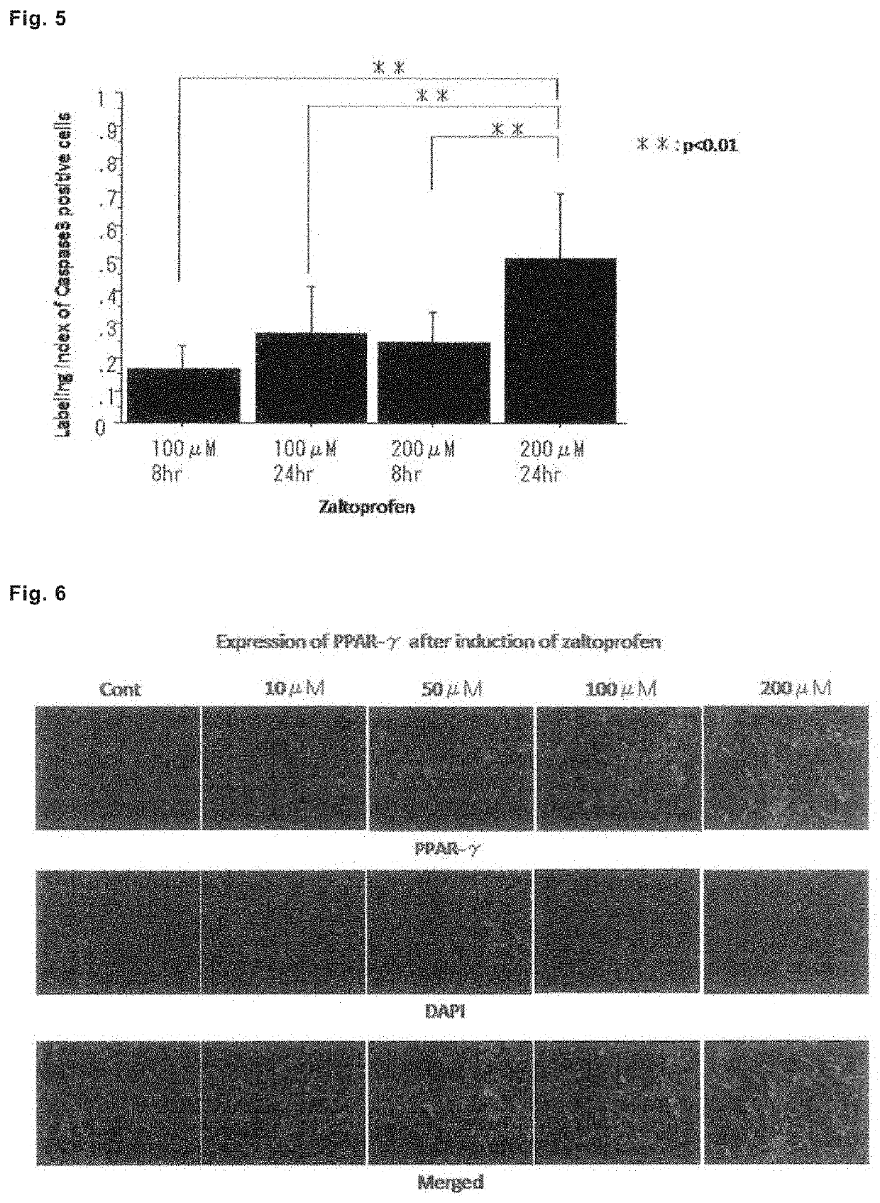 Drug for preventing, treating or preventing metastasis of giant cell tumor that occurs in bone or soft parts, chondrosarcoma, or osteosarcoma, local injection for arterial embolization, and artificial bone