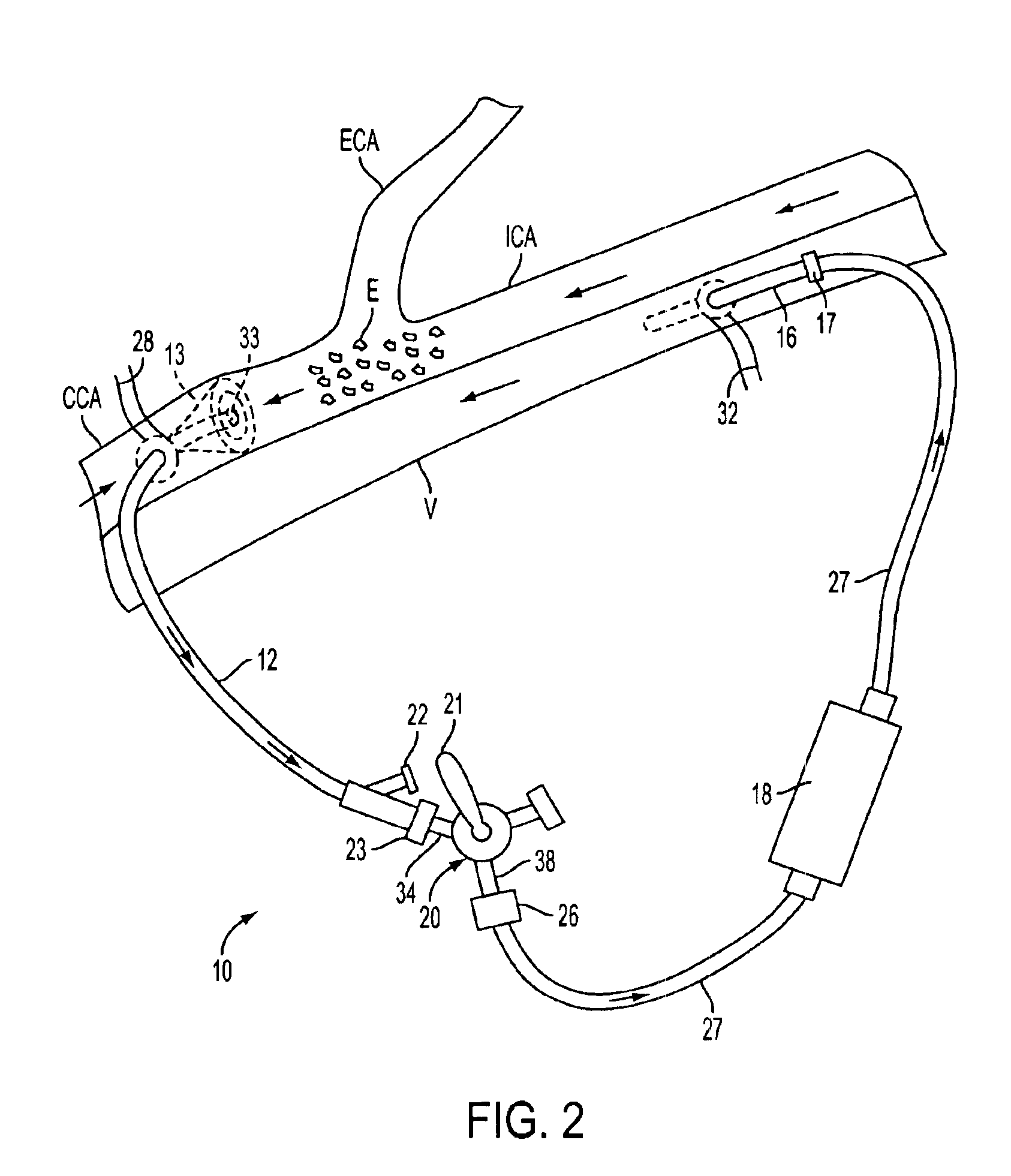 Apparatus and methods for removing emboli during a surgical procedure