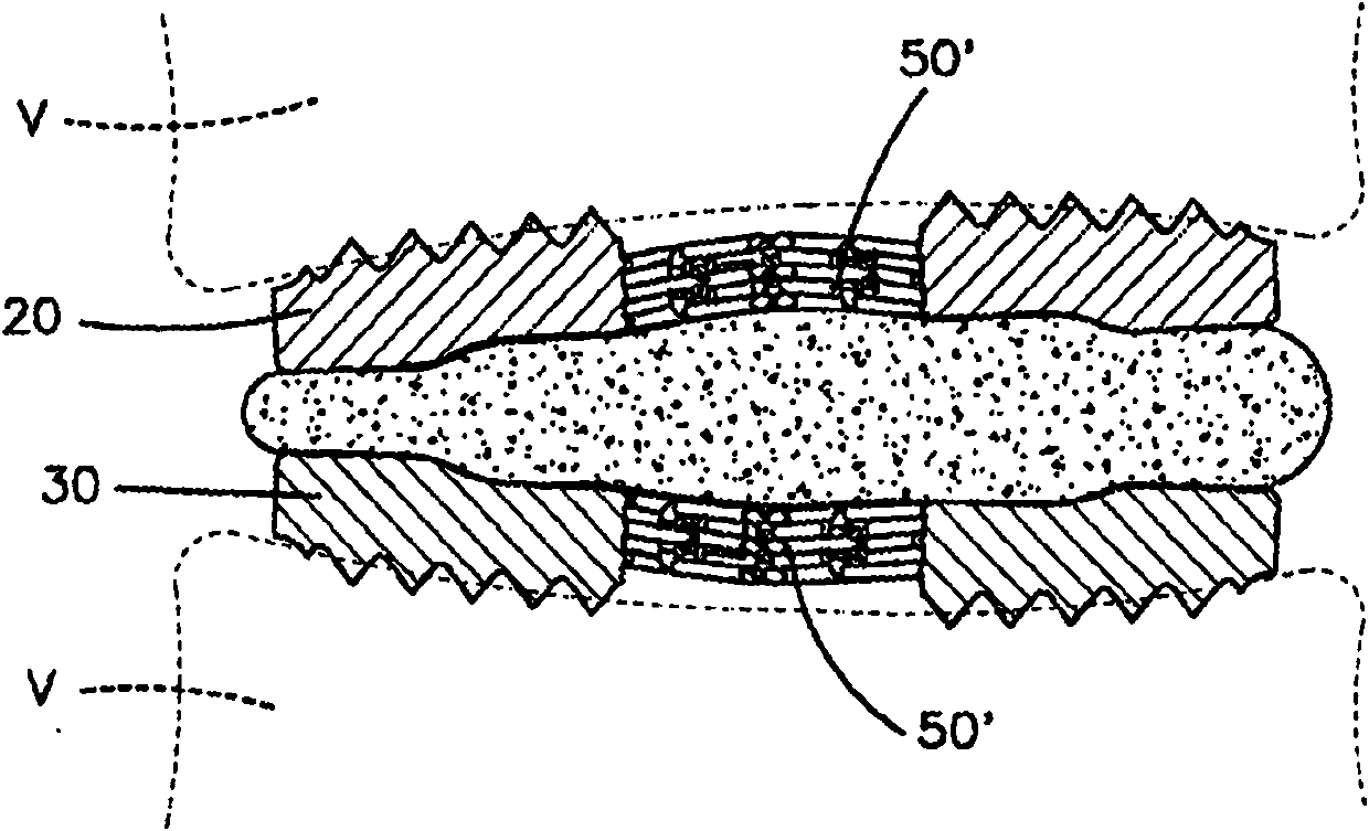 An expandable intervertebral implant and associated method of manufacturing the same