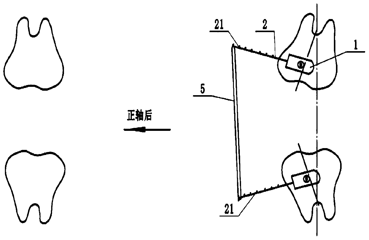 Tooth uprighting device and method