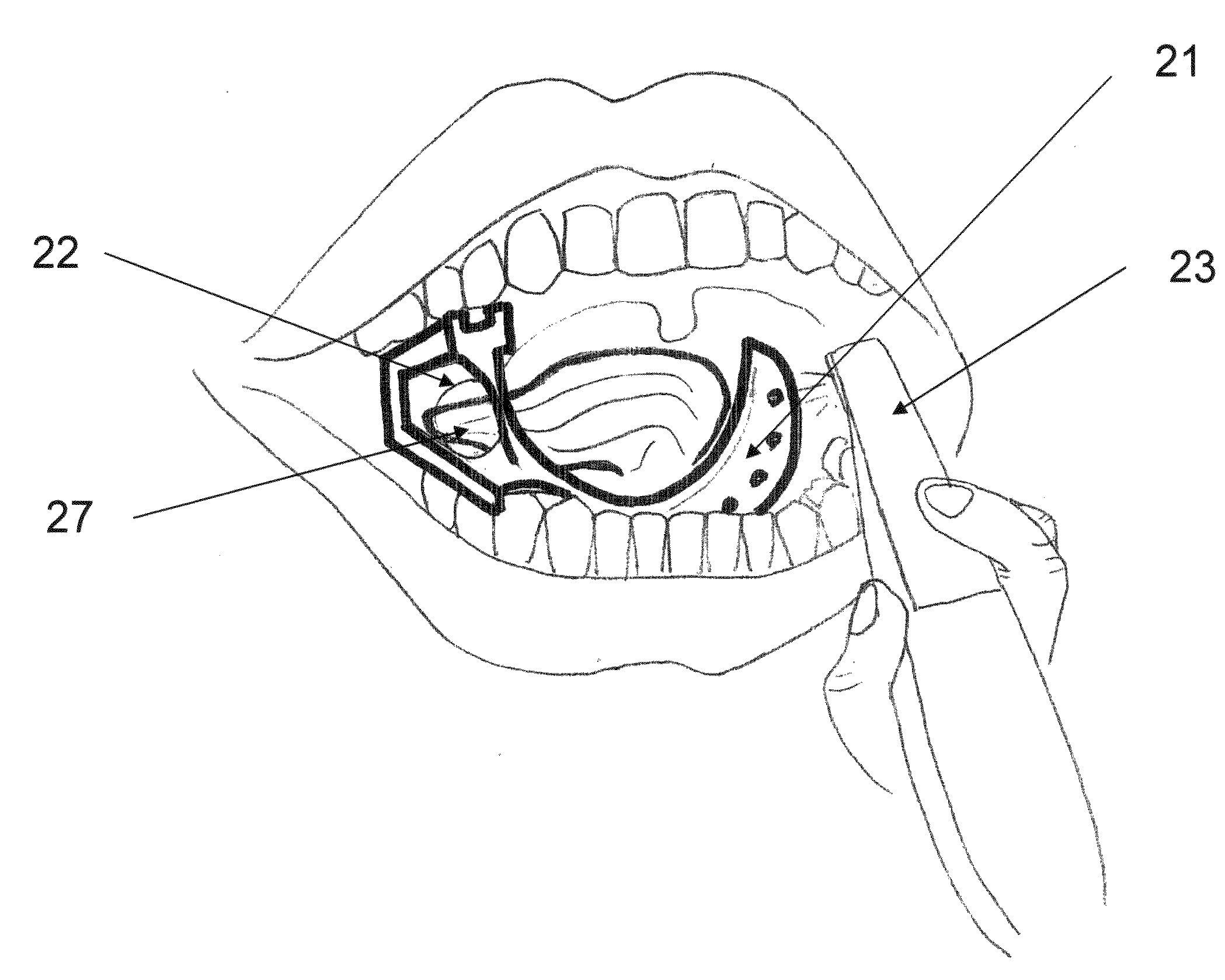 Tongue block