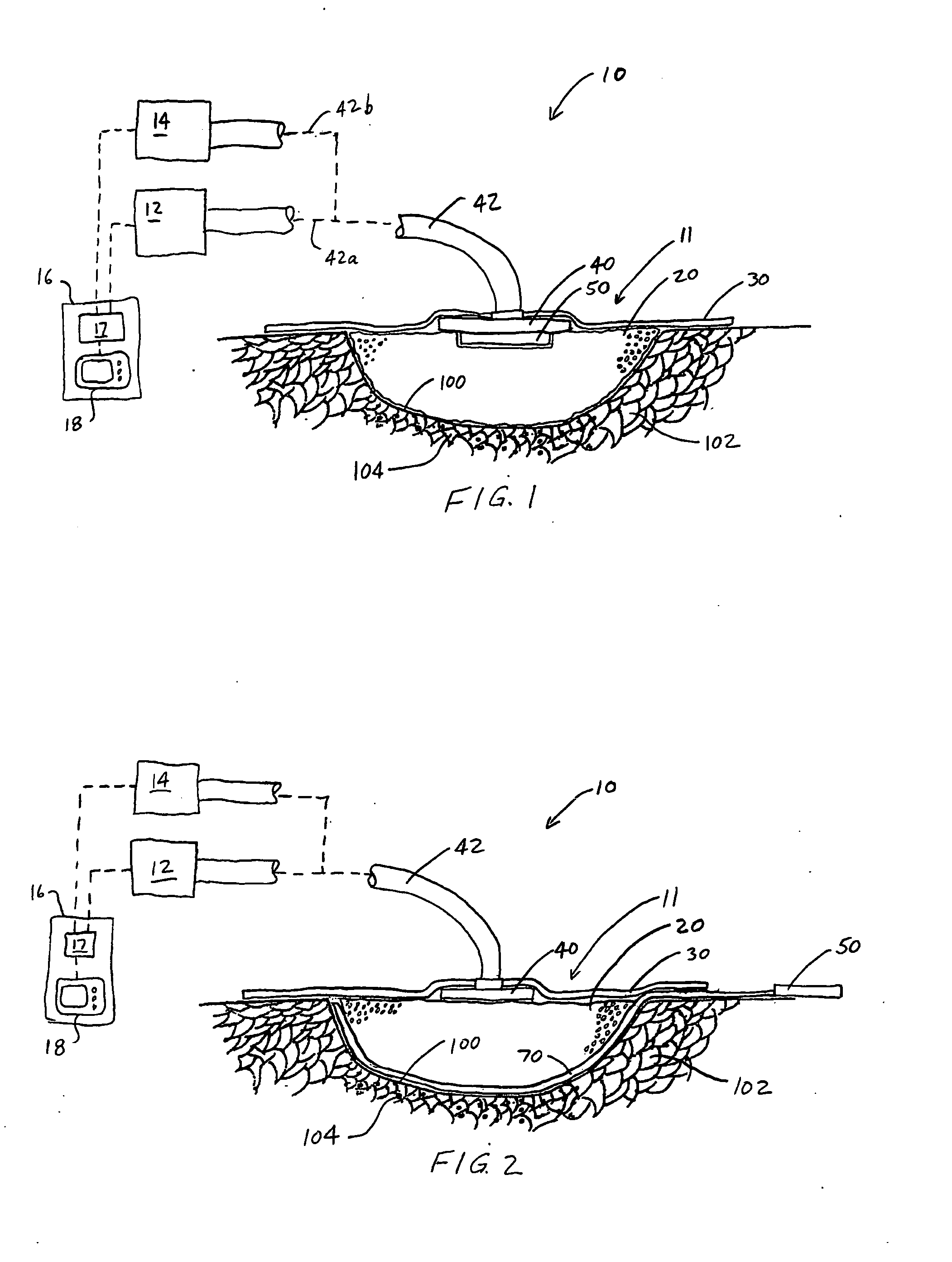 System and method for treating a wound using ultrasonic debribement