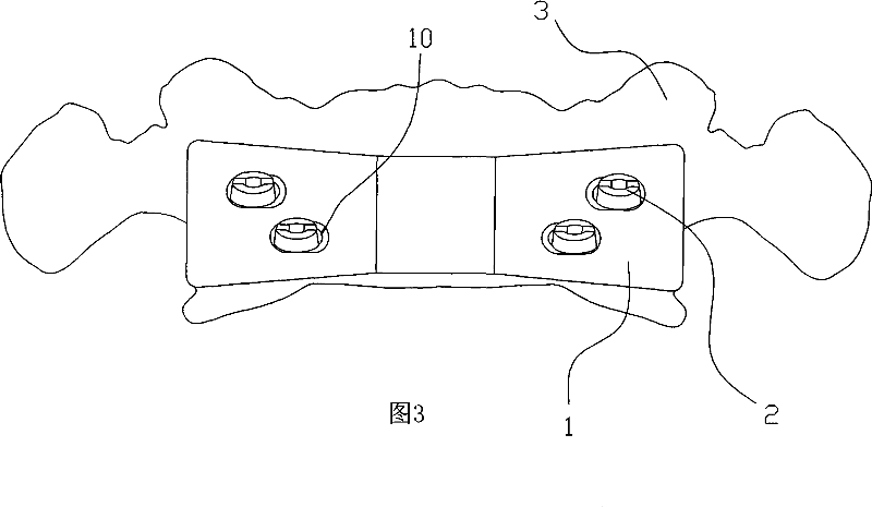 Atlas anterior arch ledger plate