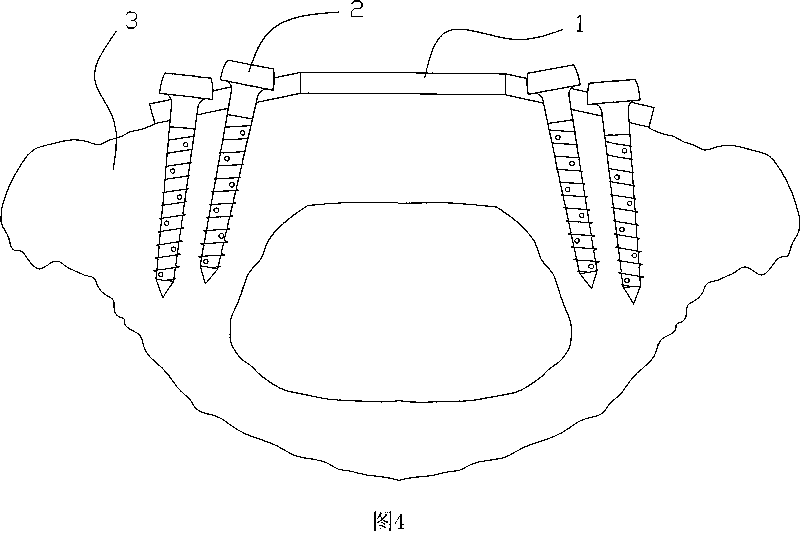 Atlas anterior arch ledger plate