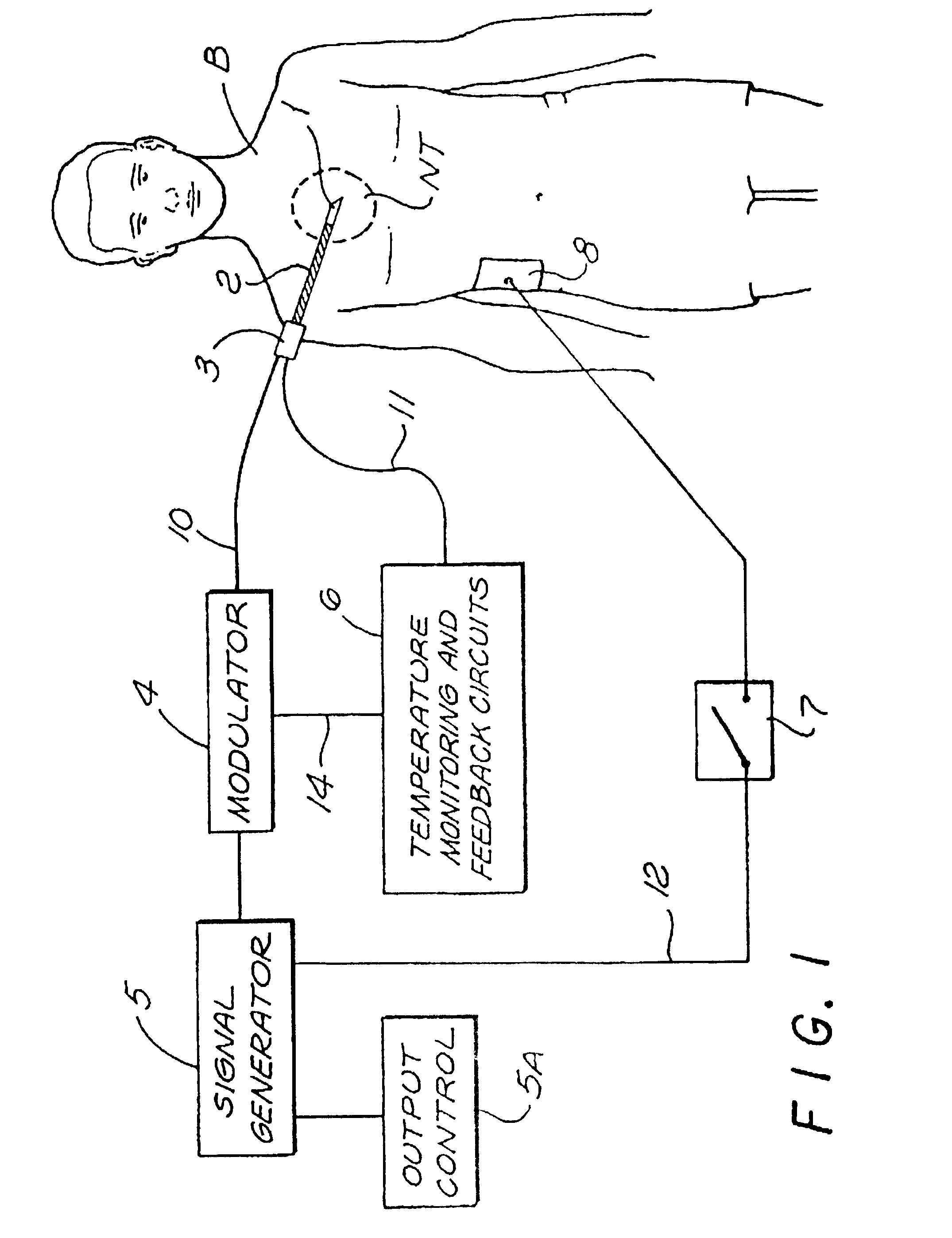 Method and system for neural tissue modification