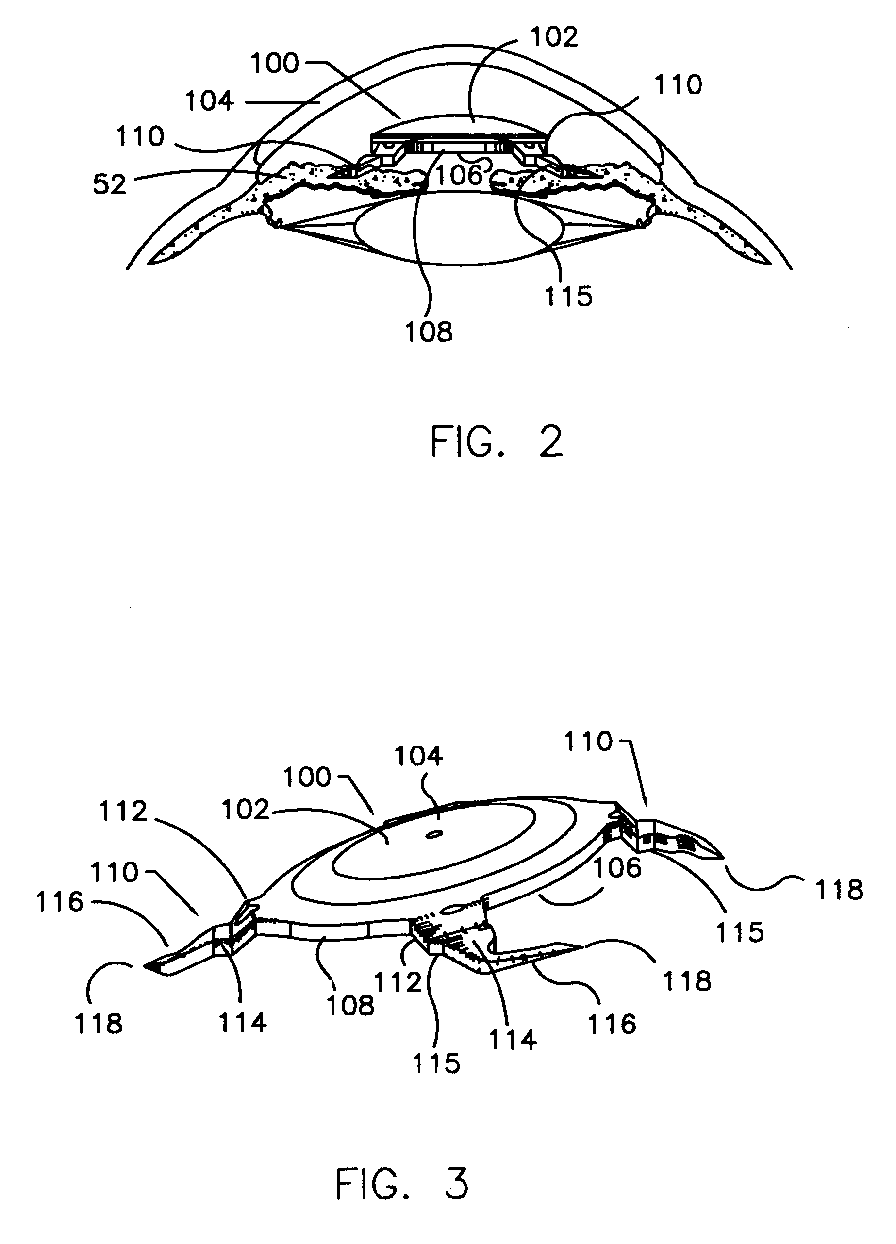 Refractive intraocular implant lens and method