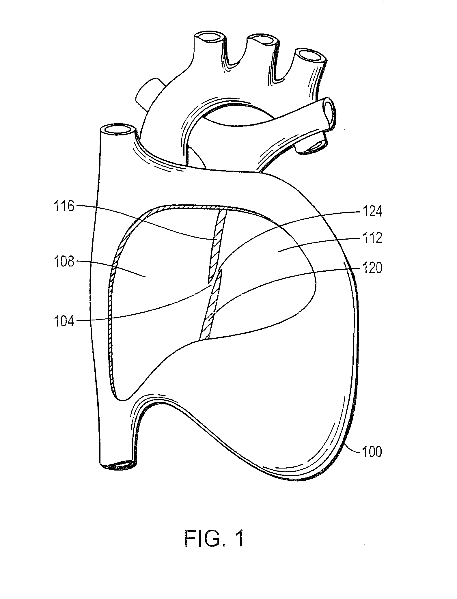 Device with Biological Tissue Scaffold for Percutaneous Closure of an Intracardiac Defect and Methods Thereof