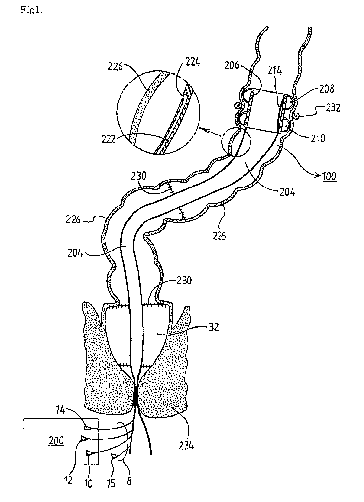 Apparatus and method for controlling fecal diverting device