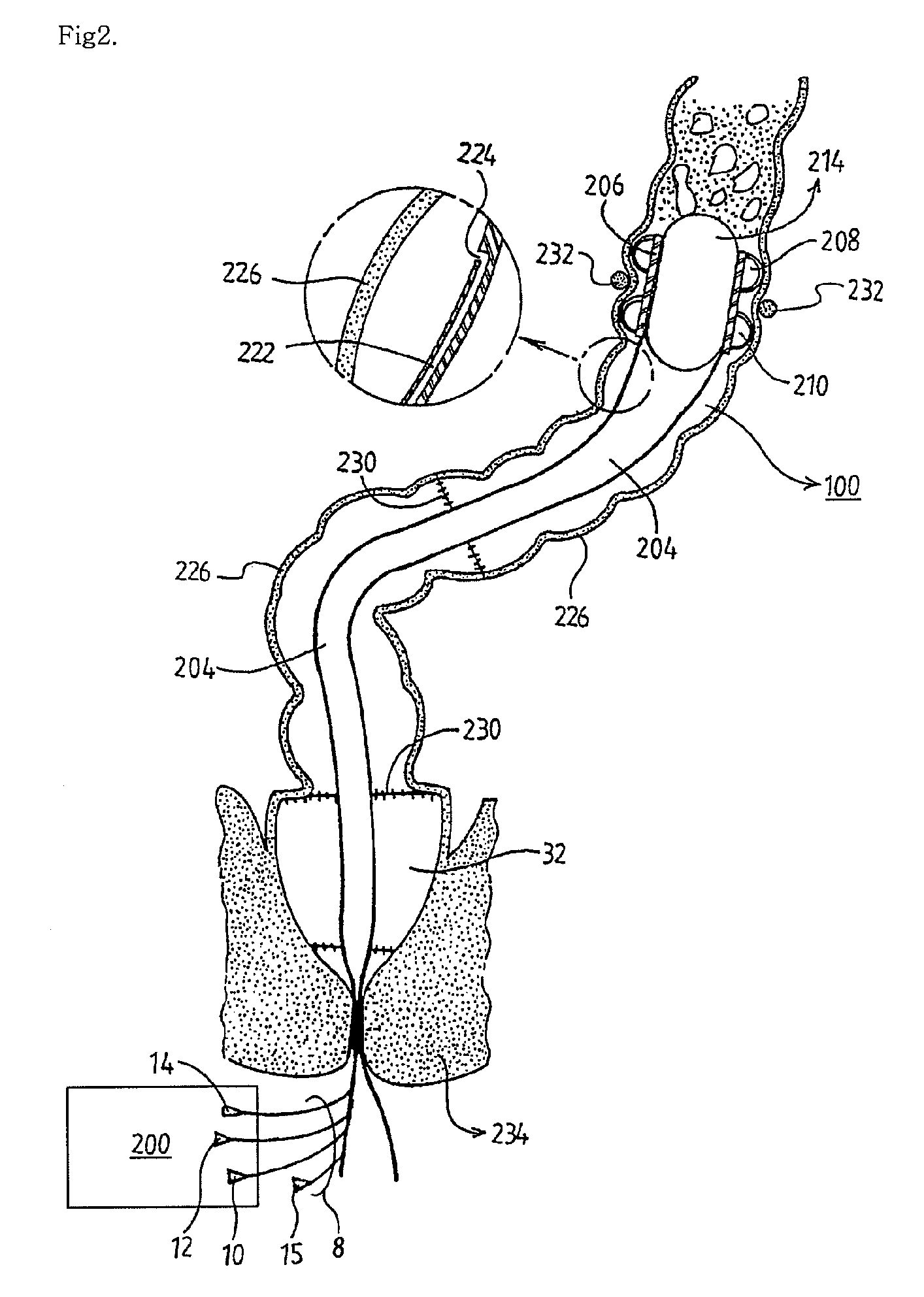 Apparatus and method for controlling fecal diverting device