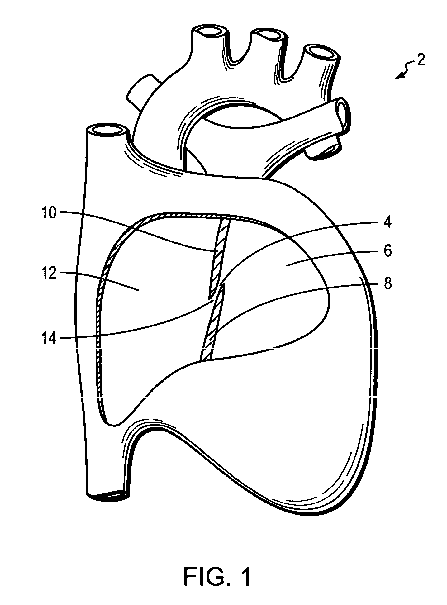 Multi-strand septal occluder