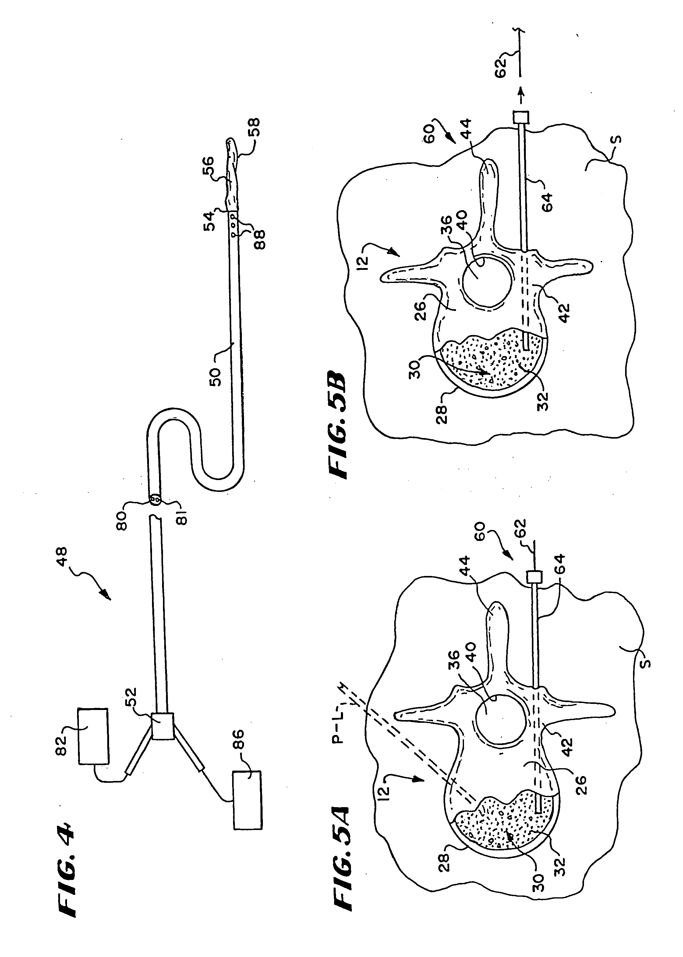 Systems and methods for treating fractured or diseased bone using expandable bodies