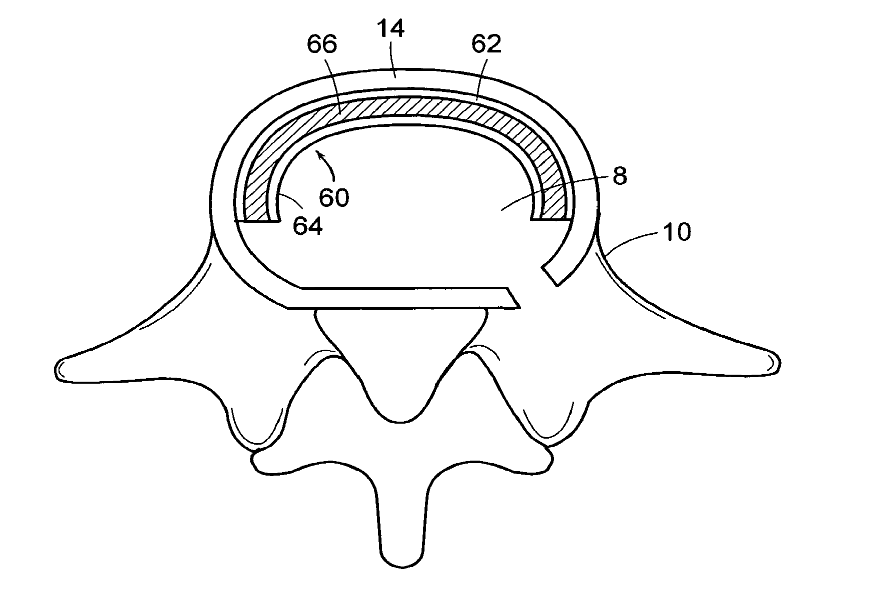 In-situ formed intervertebral fusion device and method