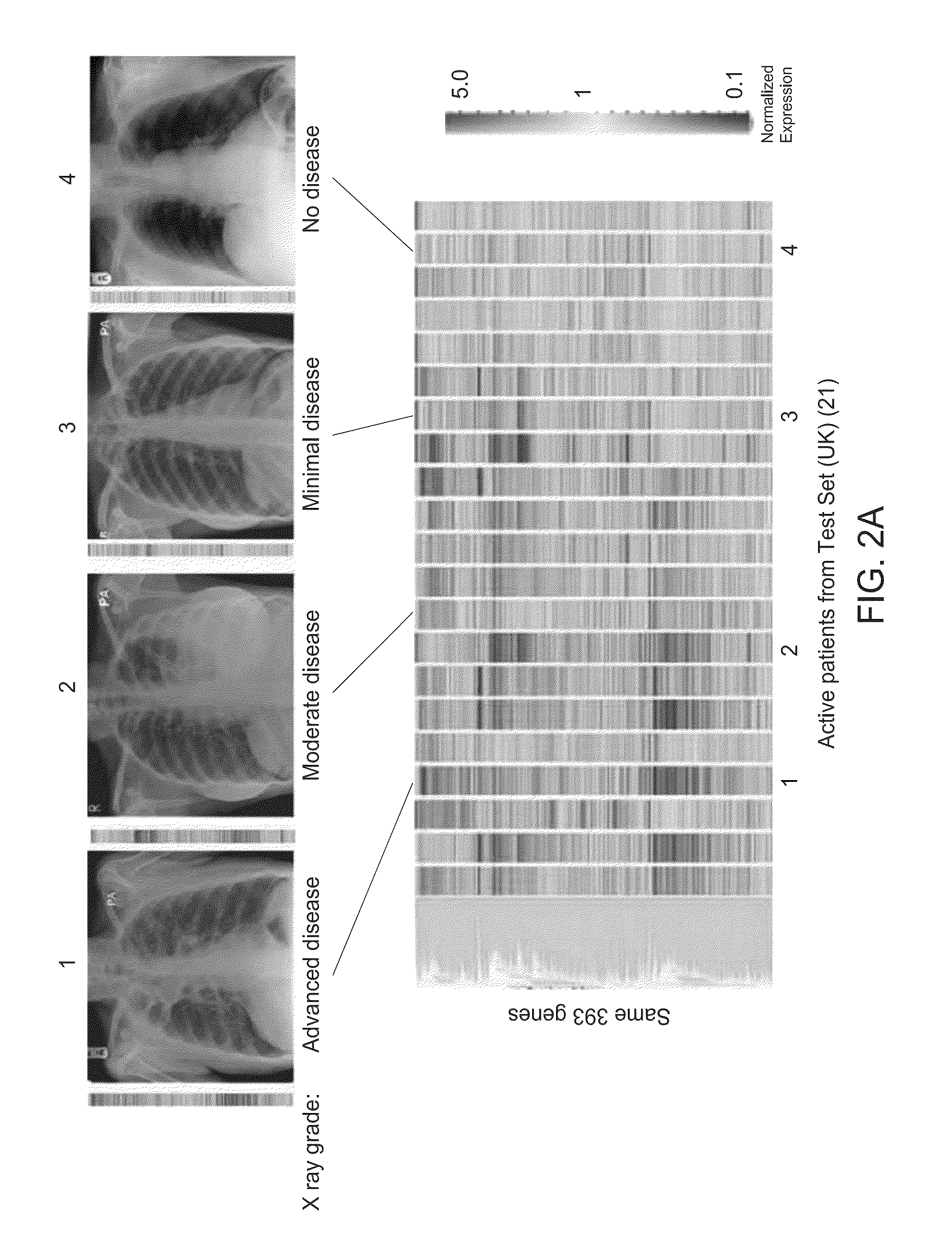 Blood transcriptional signature of active versus latent mycobacterium tuberculosis infection