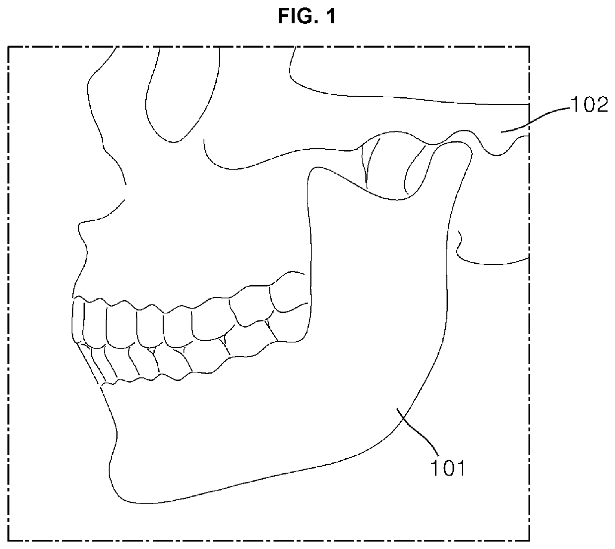 Customized artificial temporomandibular joint unit