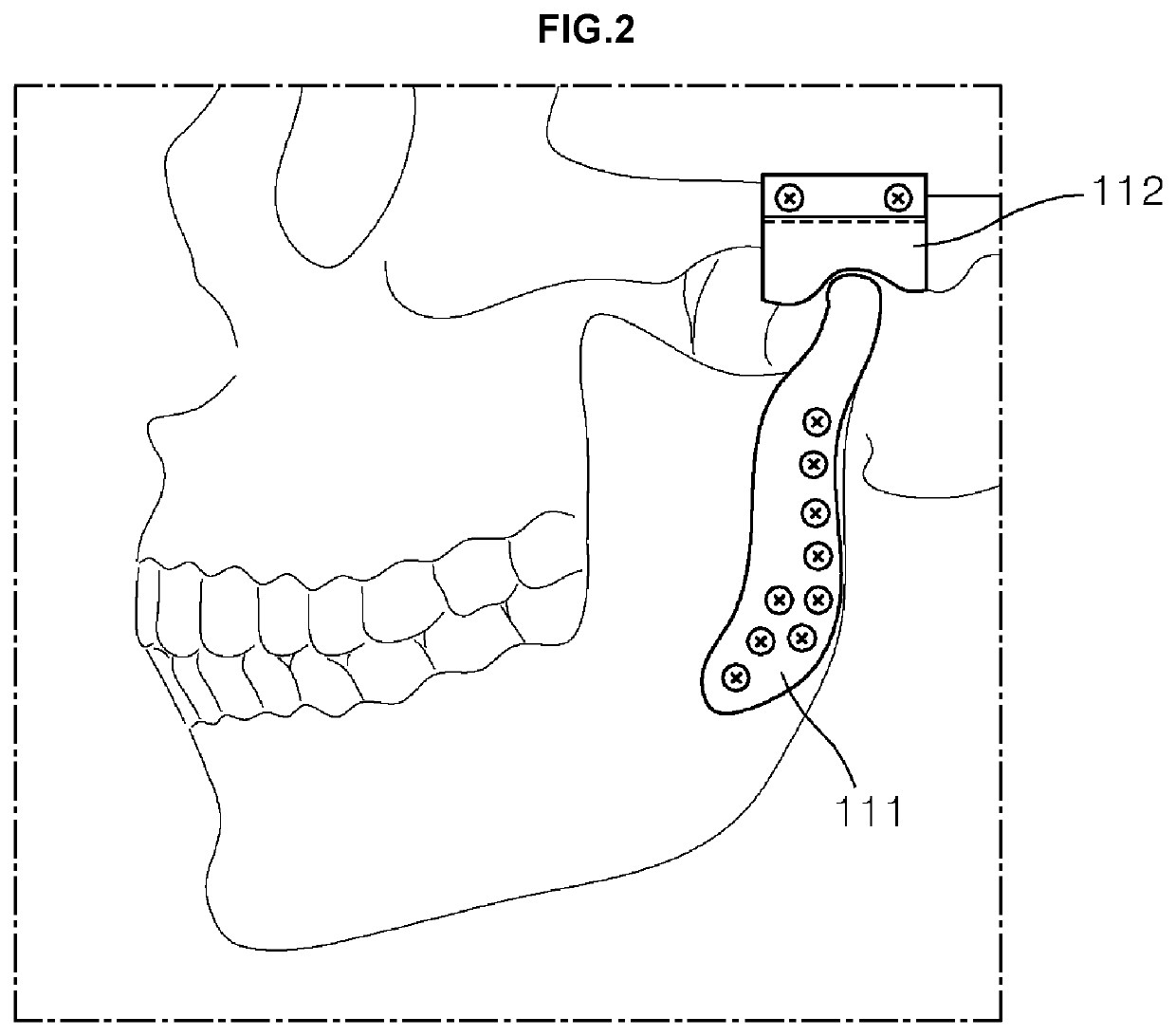 Customized artificial temporomandibular joint unit