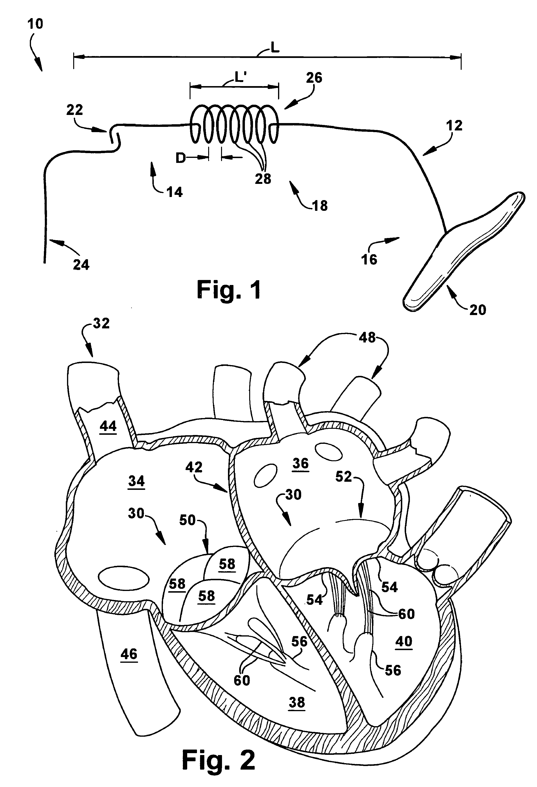 Apparatus and method for treating a regurgitant valve