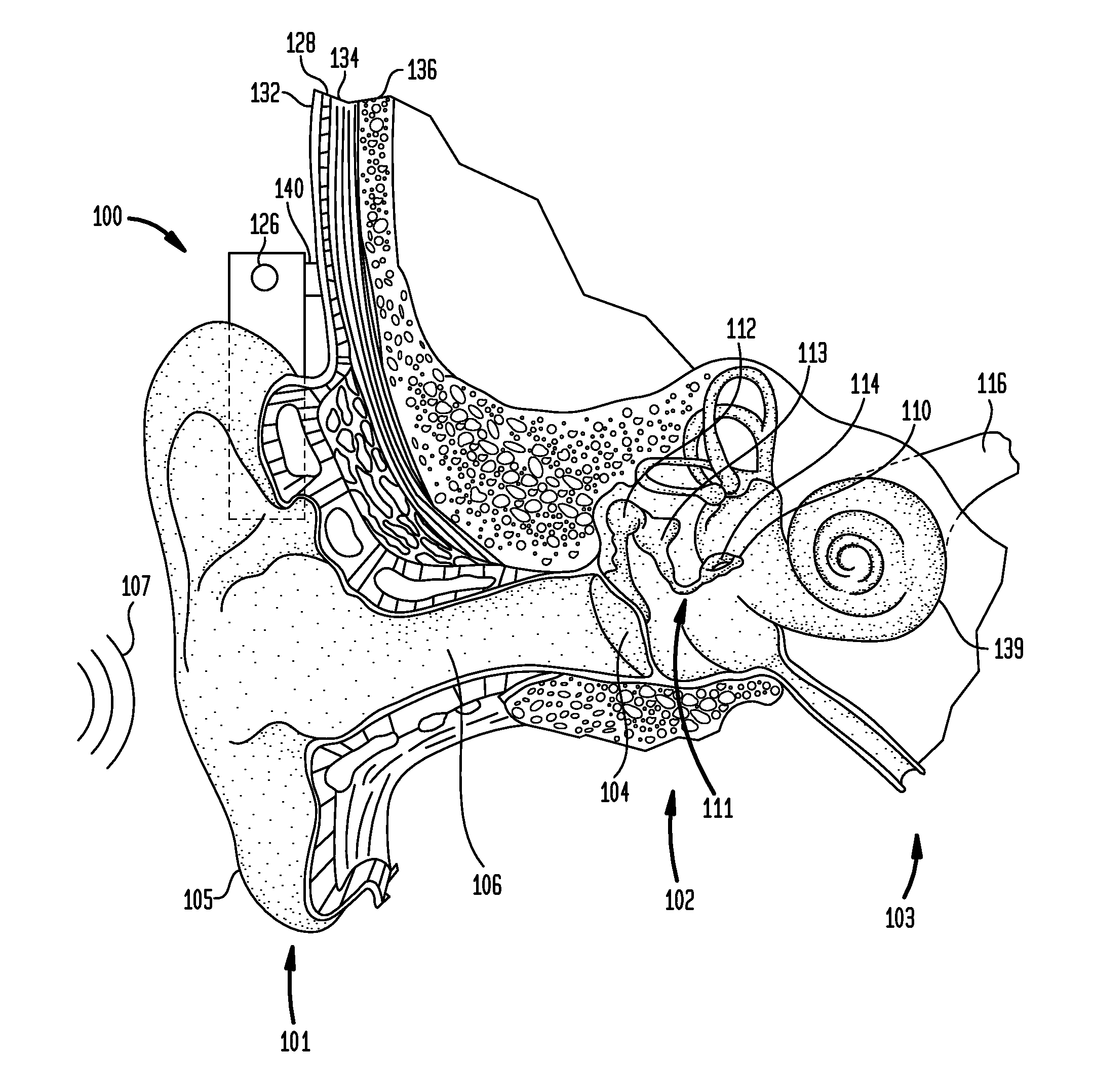 Bone conduction device including a balanced electromagnetic actuator having radial and axial air gaps