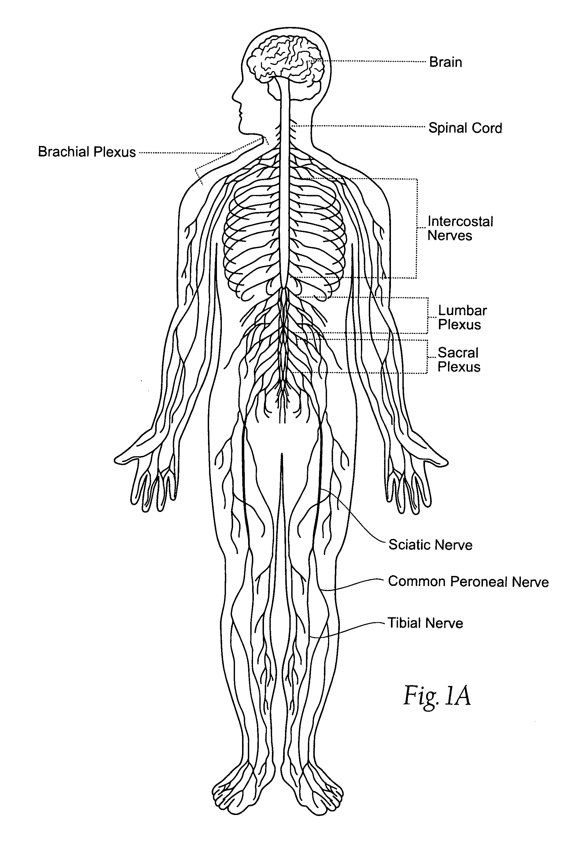 Systems and methods to place one or more leads in tissue to electrically stimulate nerves of passage to treat pain