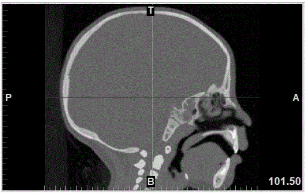 Head thin-layer CT scanning data based frontal bone angle measurement method