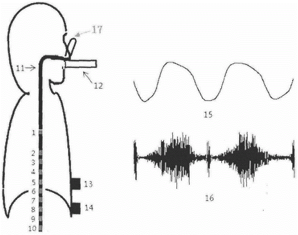 Airway resistance judgment based on diaphragmatic electromyogram