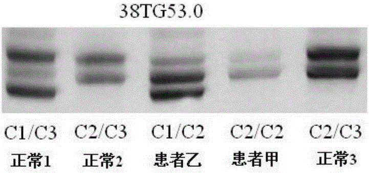 Neurofibromatosis type I virulence gene mutation and etiological diagnosis agent based on neurofibromatosis type I virulence gene mutation