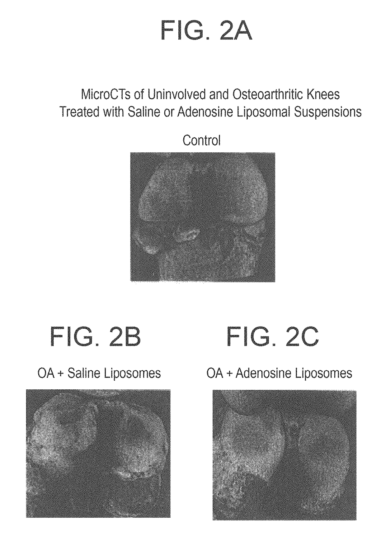 Methods and compositions for treating osteoarthritis and promoting cartilage formation