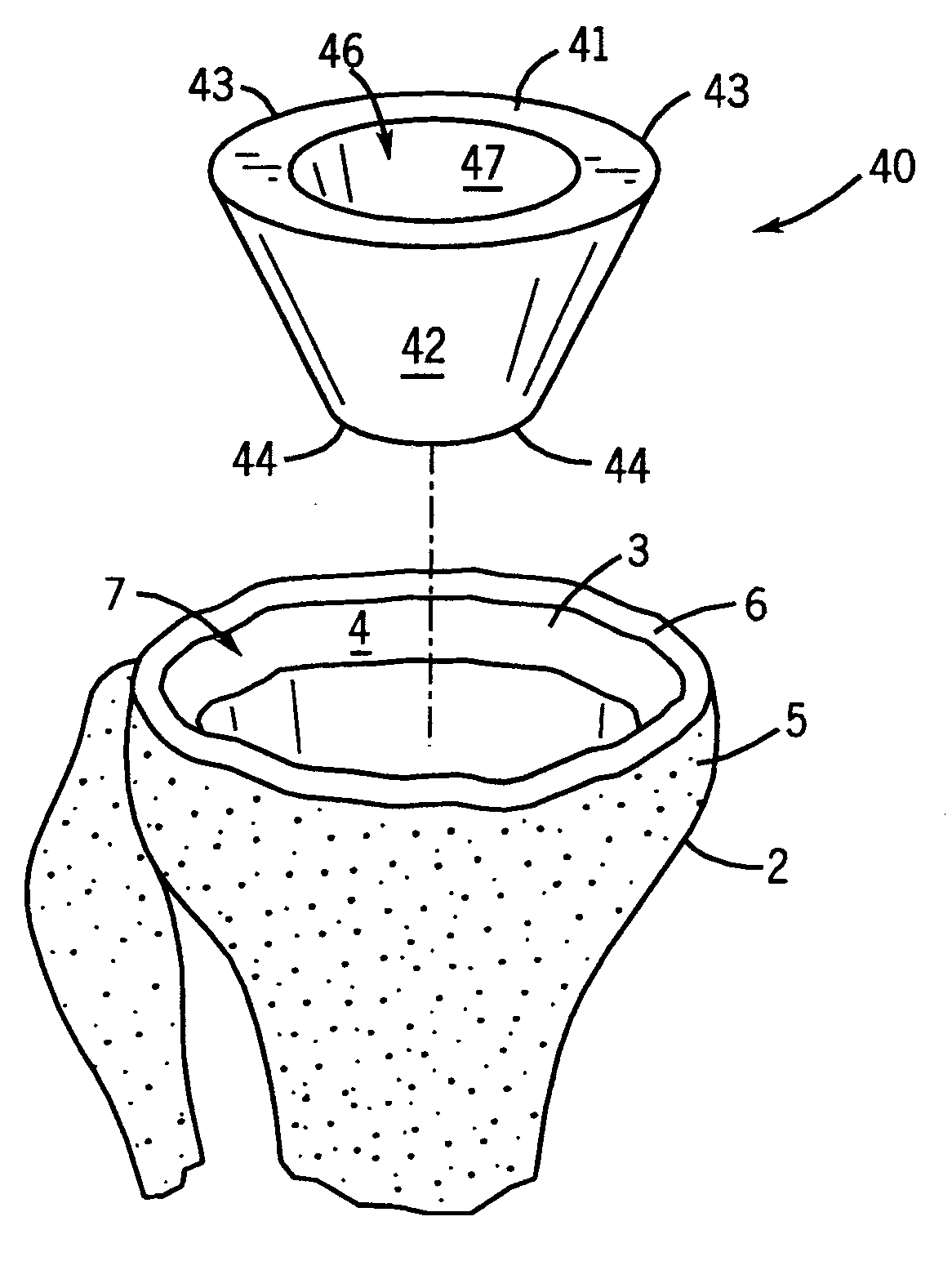 Prosthetic implant support structure