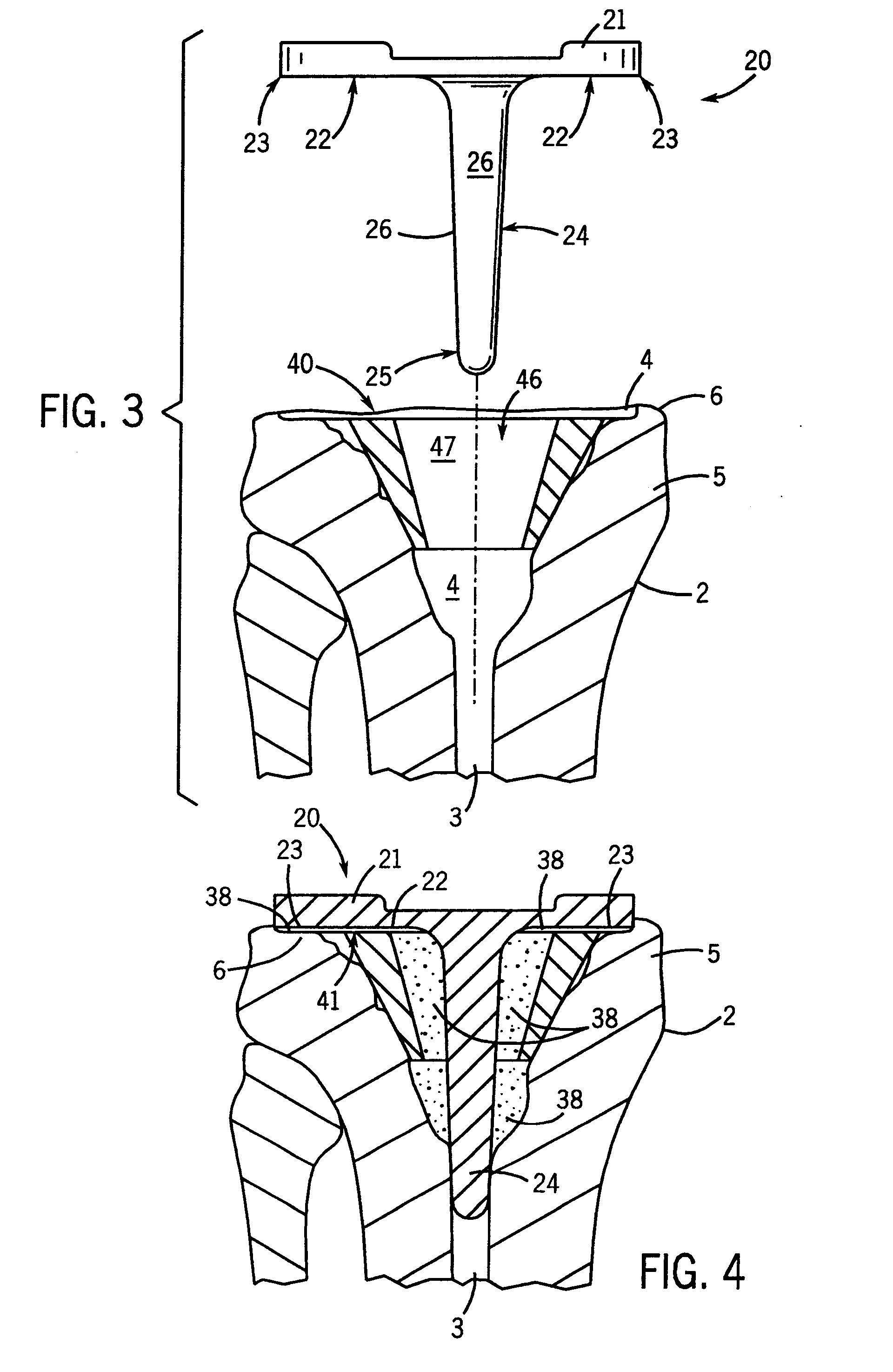 Prosthetic implant support structure