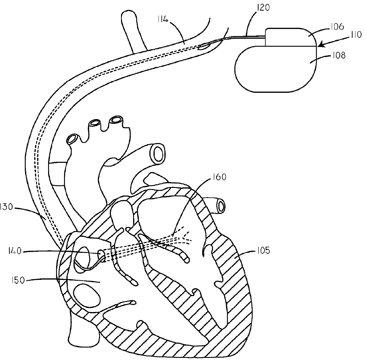 Temperature based systems and methods for tachycardia discrimination and therapy