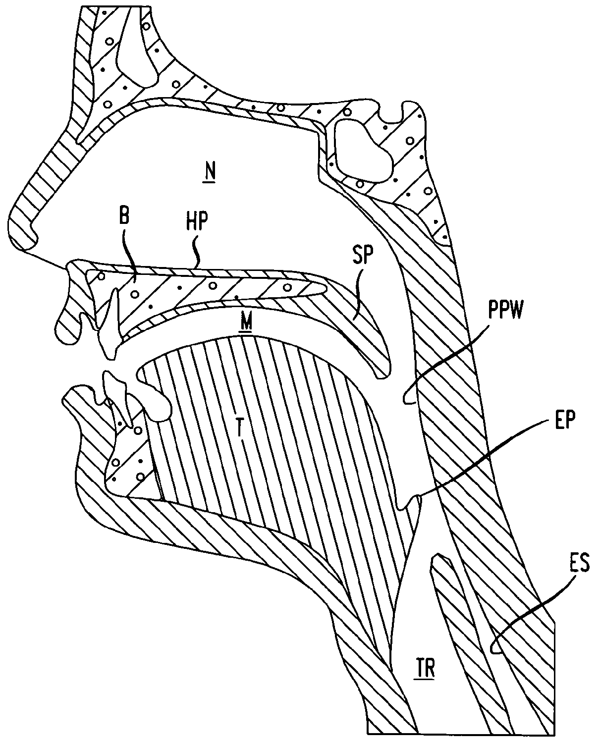 Methods and devices for treatment of obstructive sleep apnea
