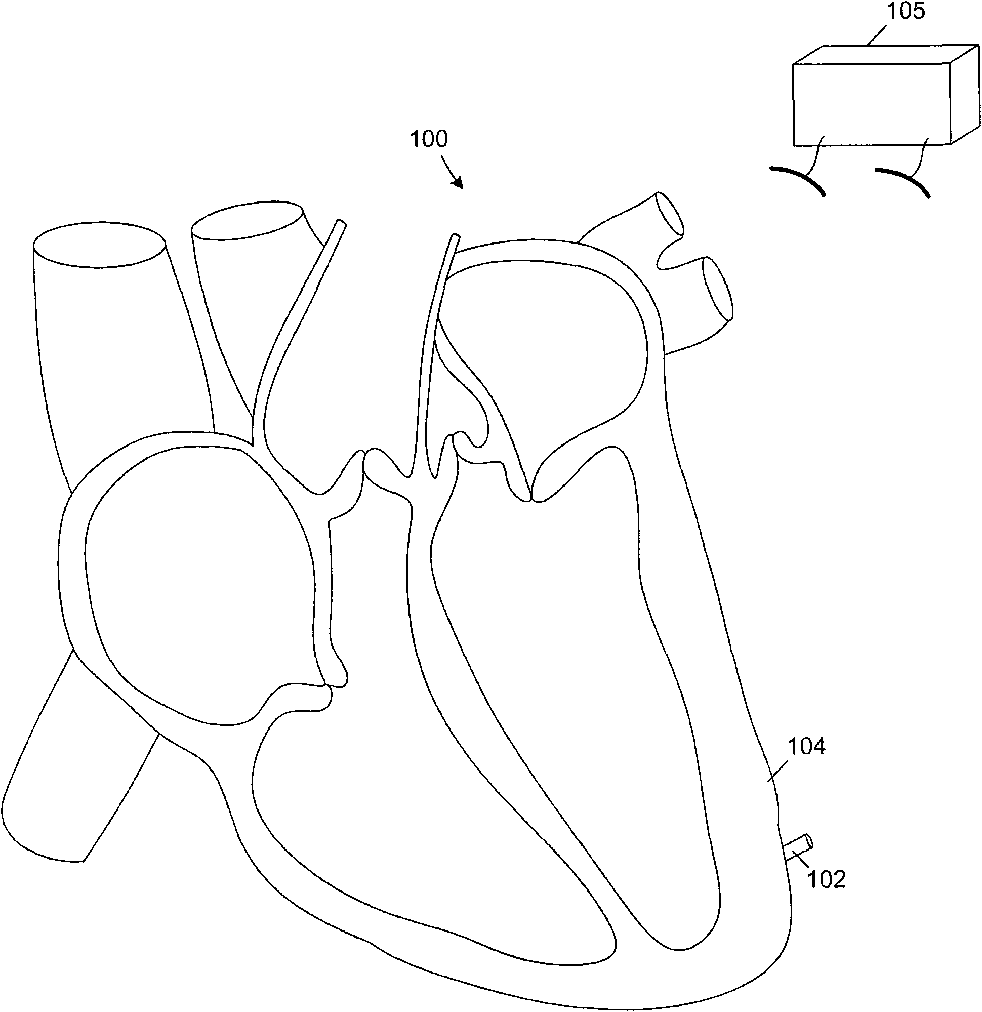 Leadless cardiac pacemaker and system