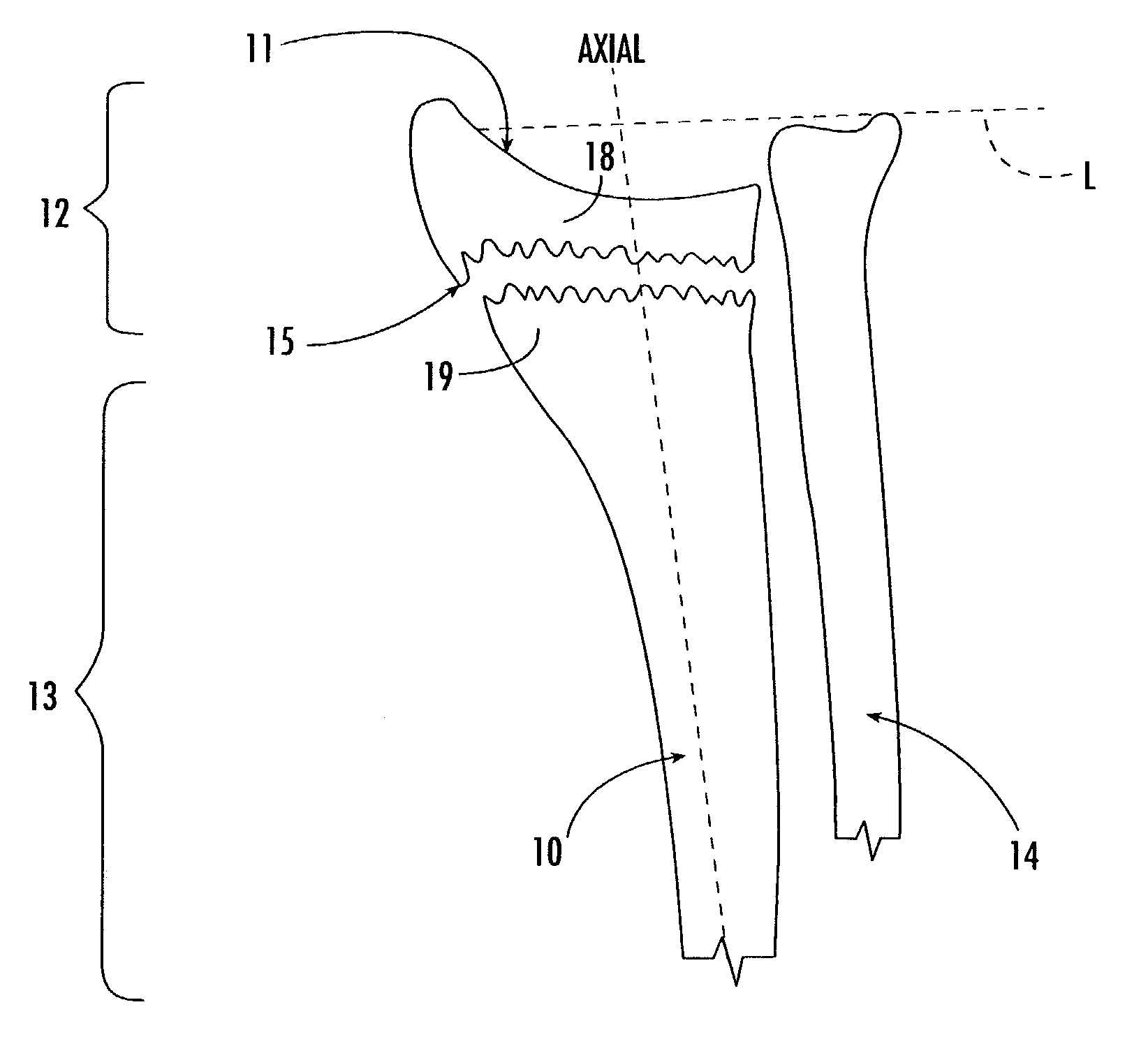 Intramedullary interlocking fixation device for the distal radius
