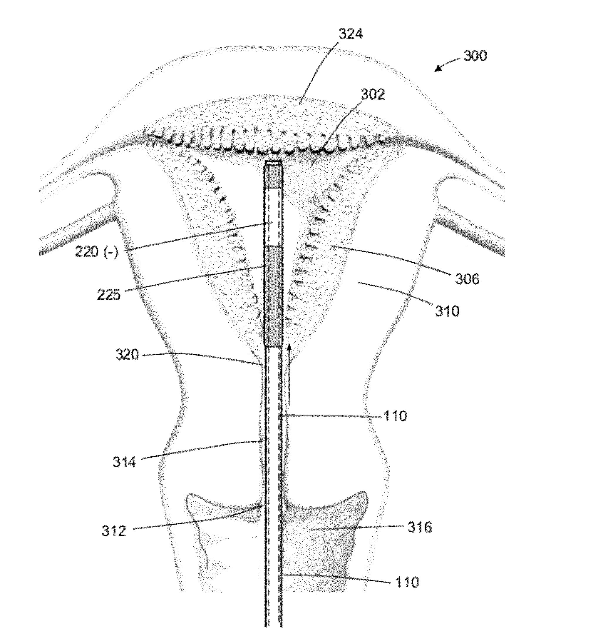 Systems and methods for endometrial ablation