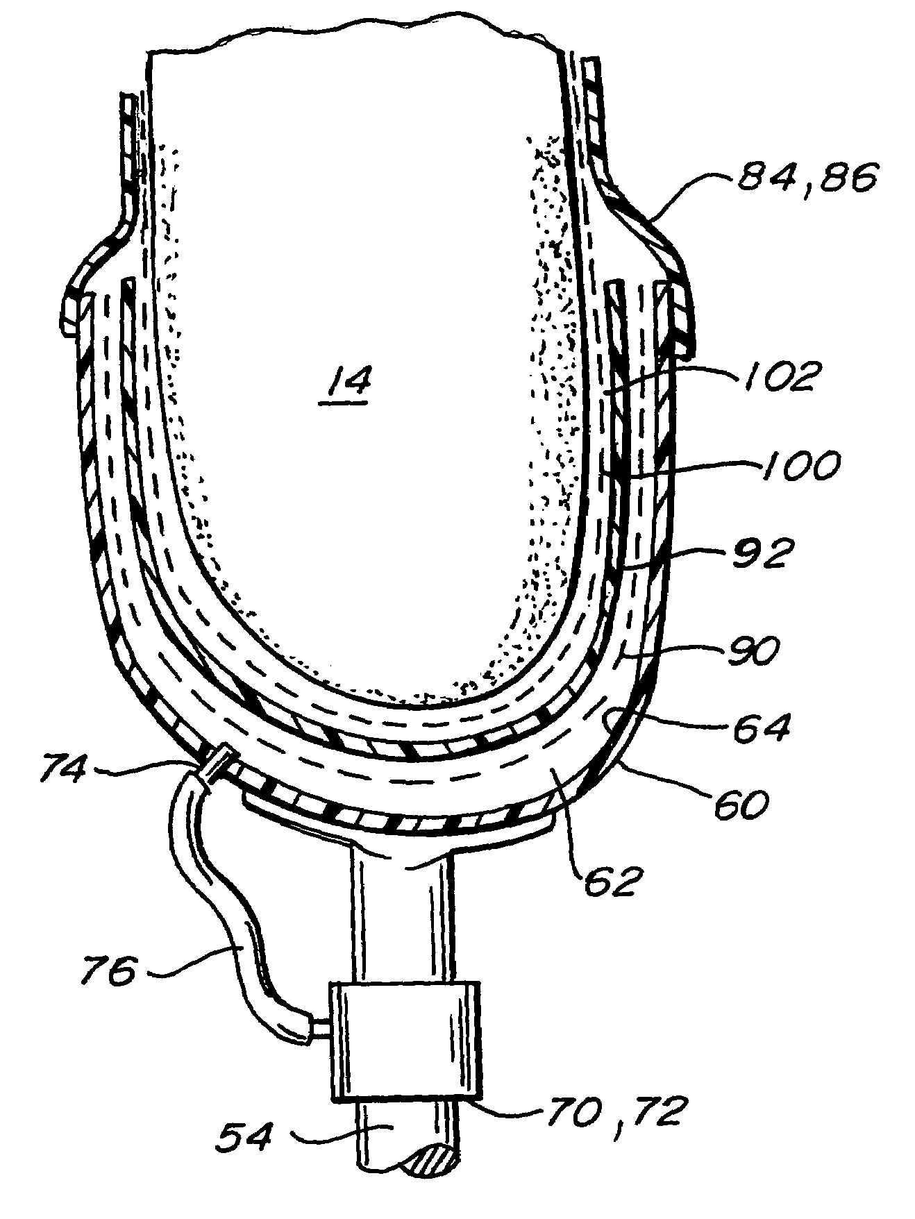 Osmotic membrane and vacuum system for artificial limb