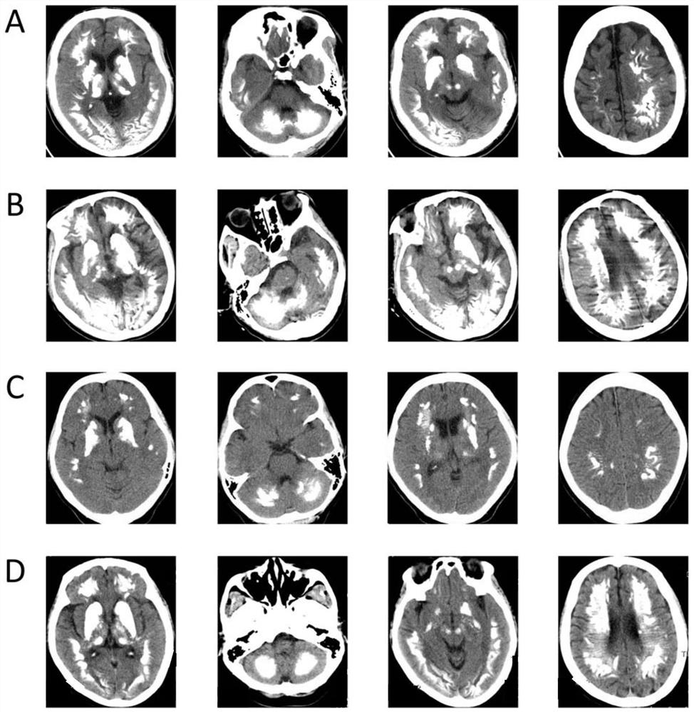 Primary familial cerebral calcification pathogenic gene jam2 and its application