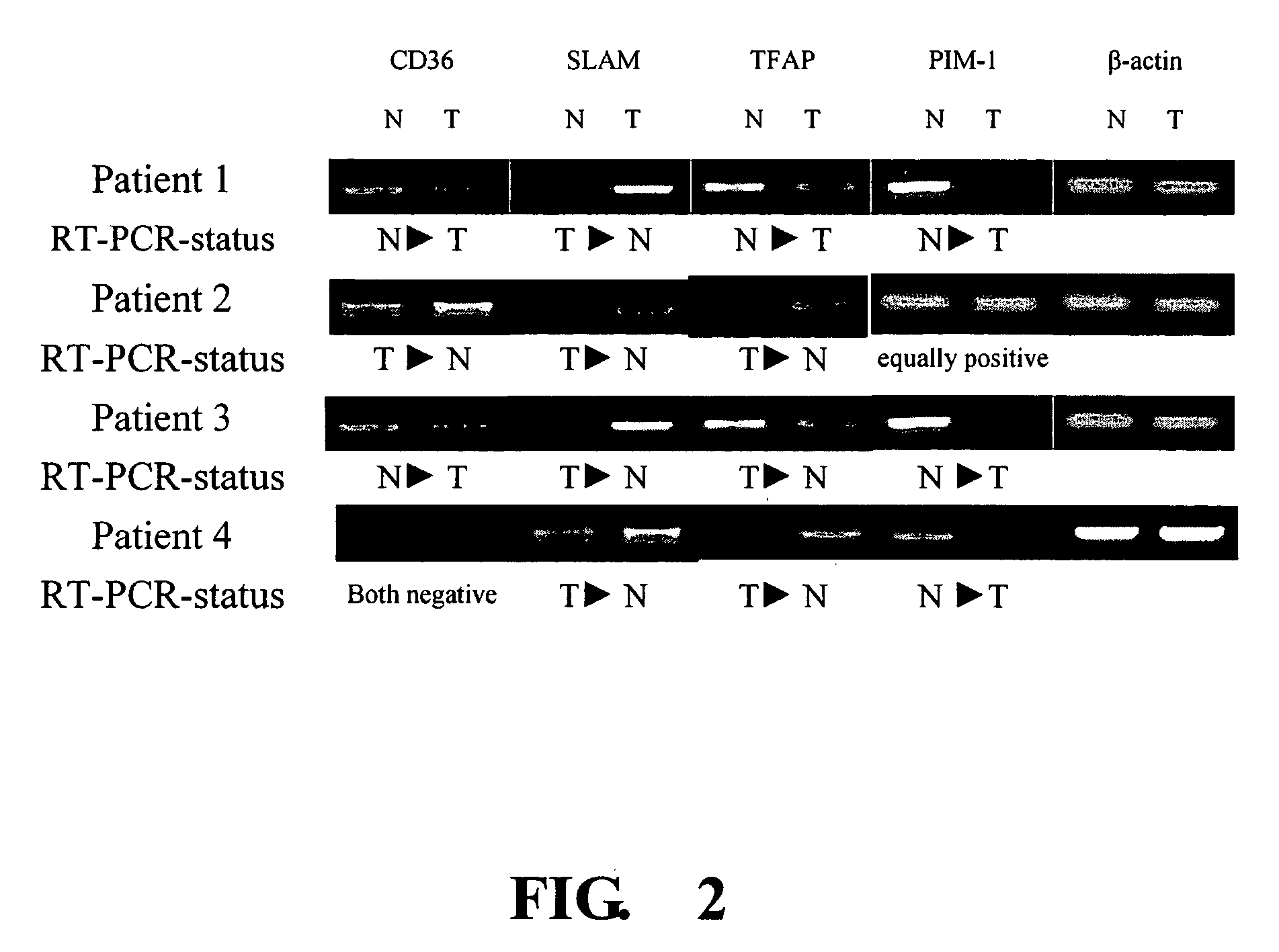 Method for survival prediction in gastric cancer patients after surgical operation using gene expression profiles and application thereof