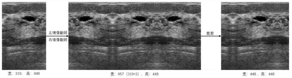 Breast ultrasound image tumor segmentation method