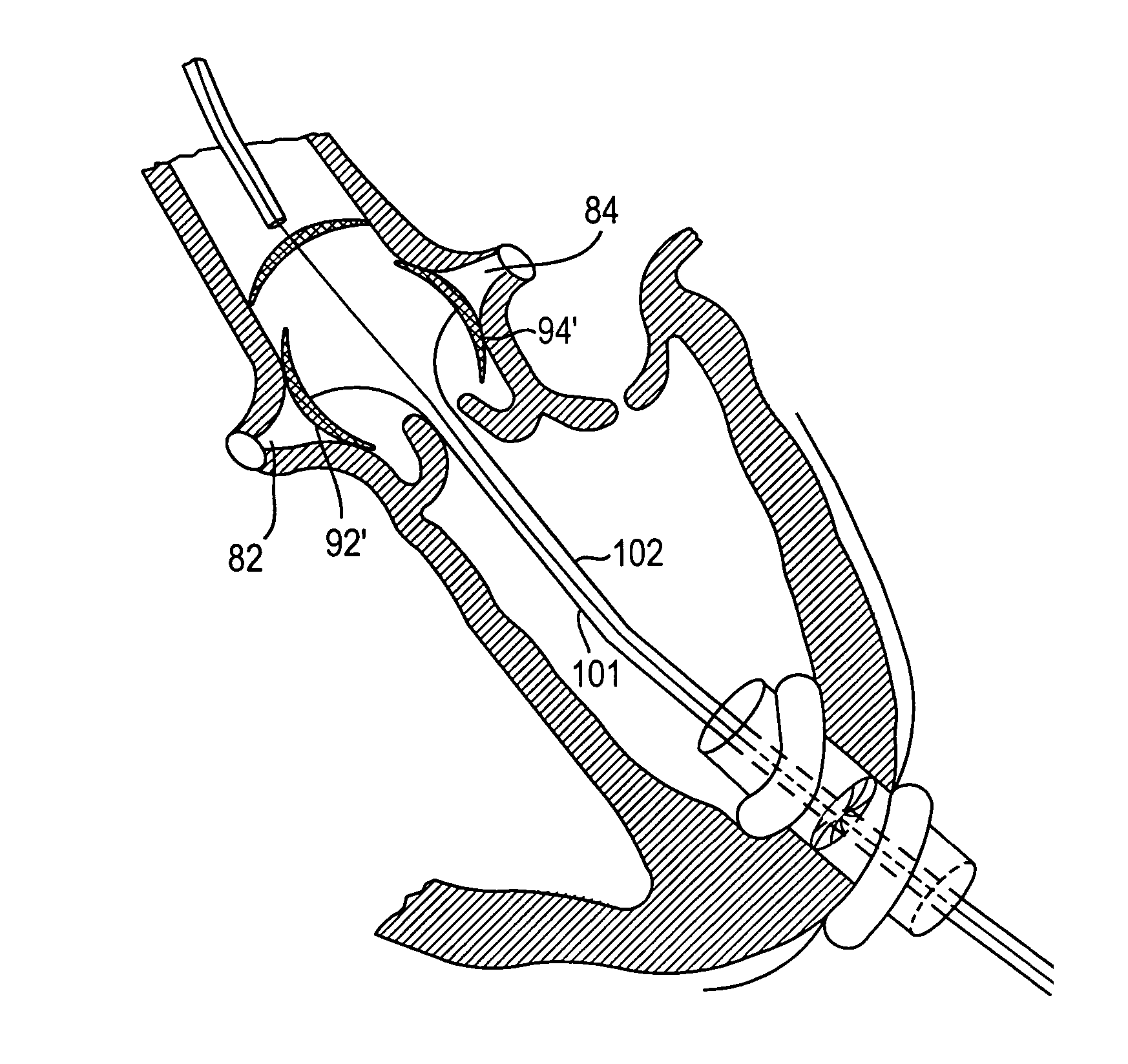 Methods and devices for repair or replacement of heart valves or adjacent tissue without the need for full cardiopulmonary support