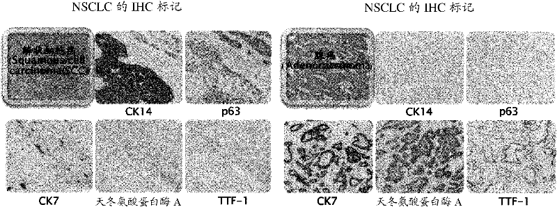 Cocktail antibody for determining histological type of carcinoma, determination kit and determination method