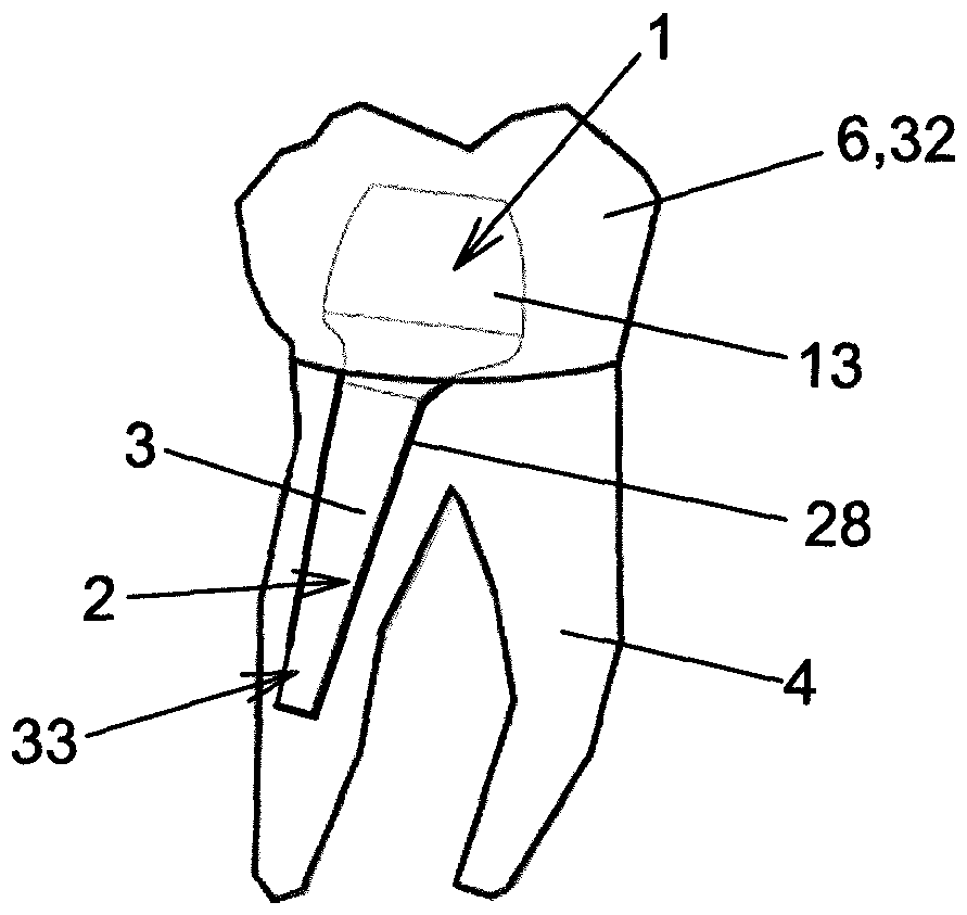endodontic pin