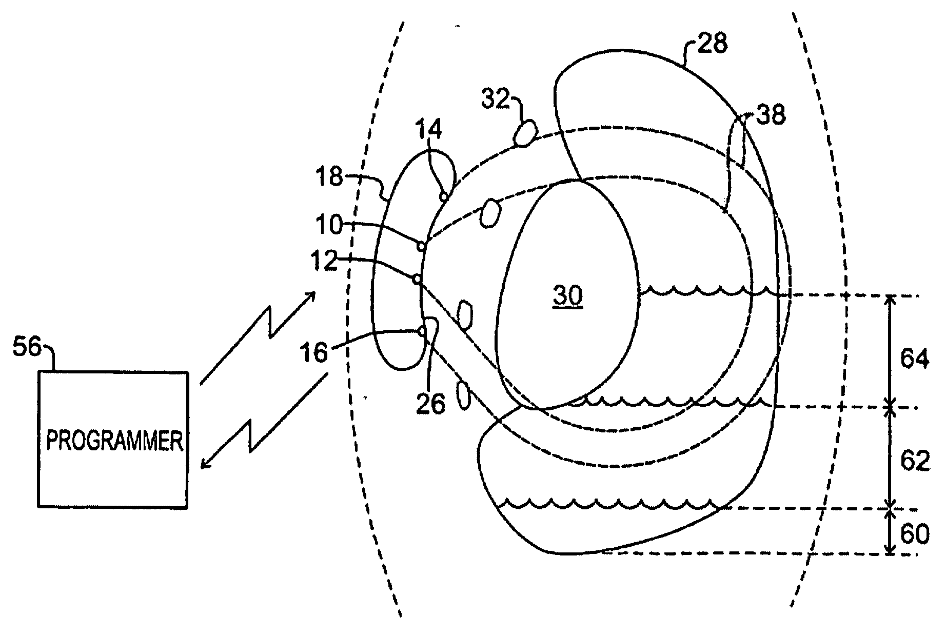 Remote Control of Implantable Device Through Medical Implant Communication Service Band