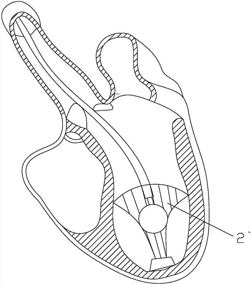 Cardiac apex mediated heart volume reduction implant