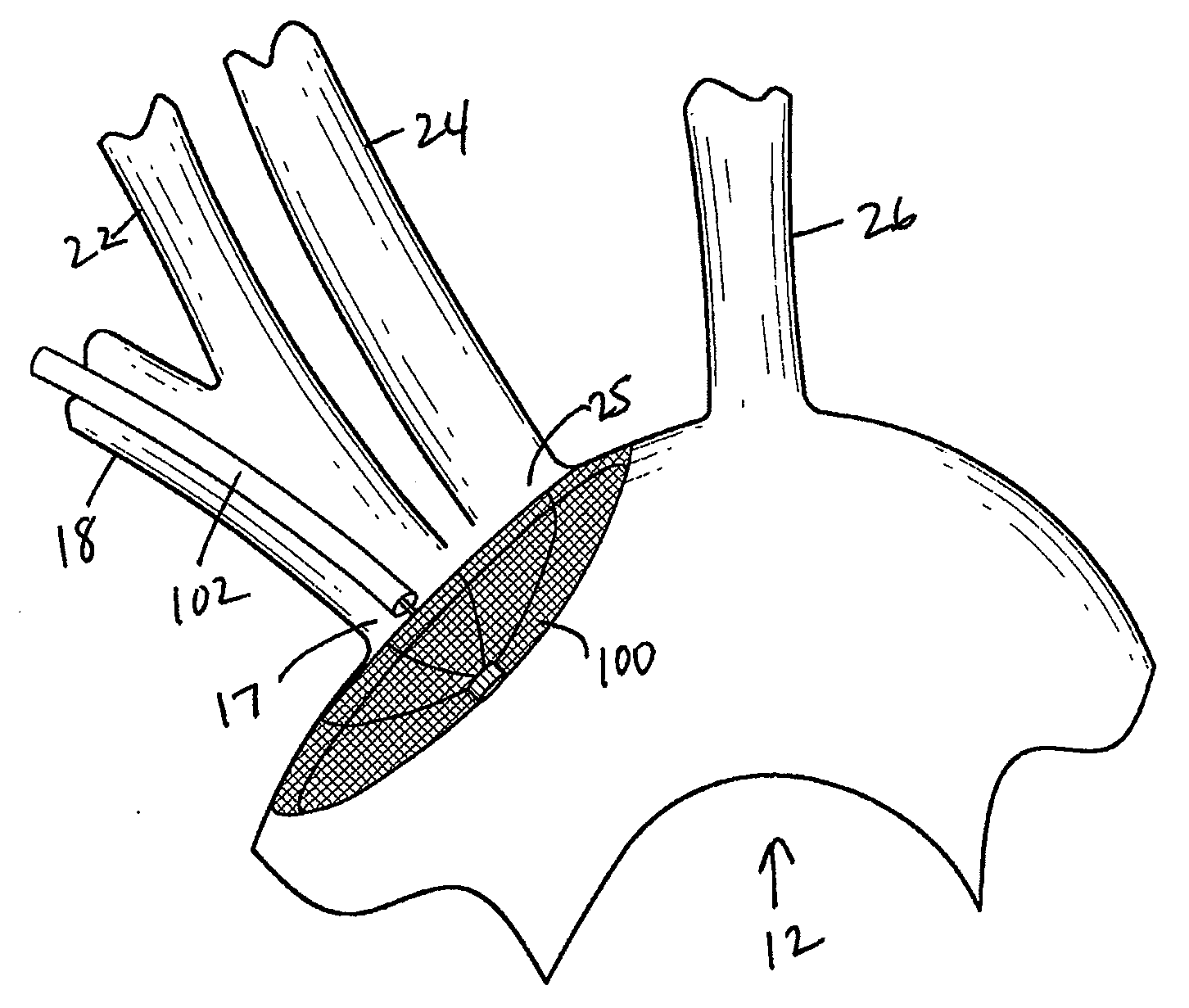 Methods of deploying and retrieving an embolic diversion device