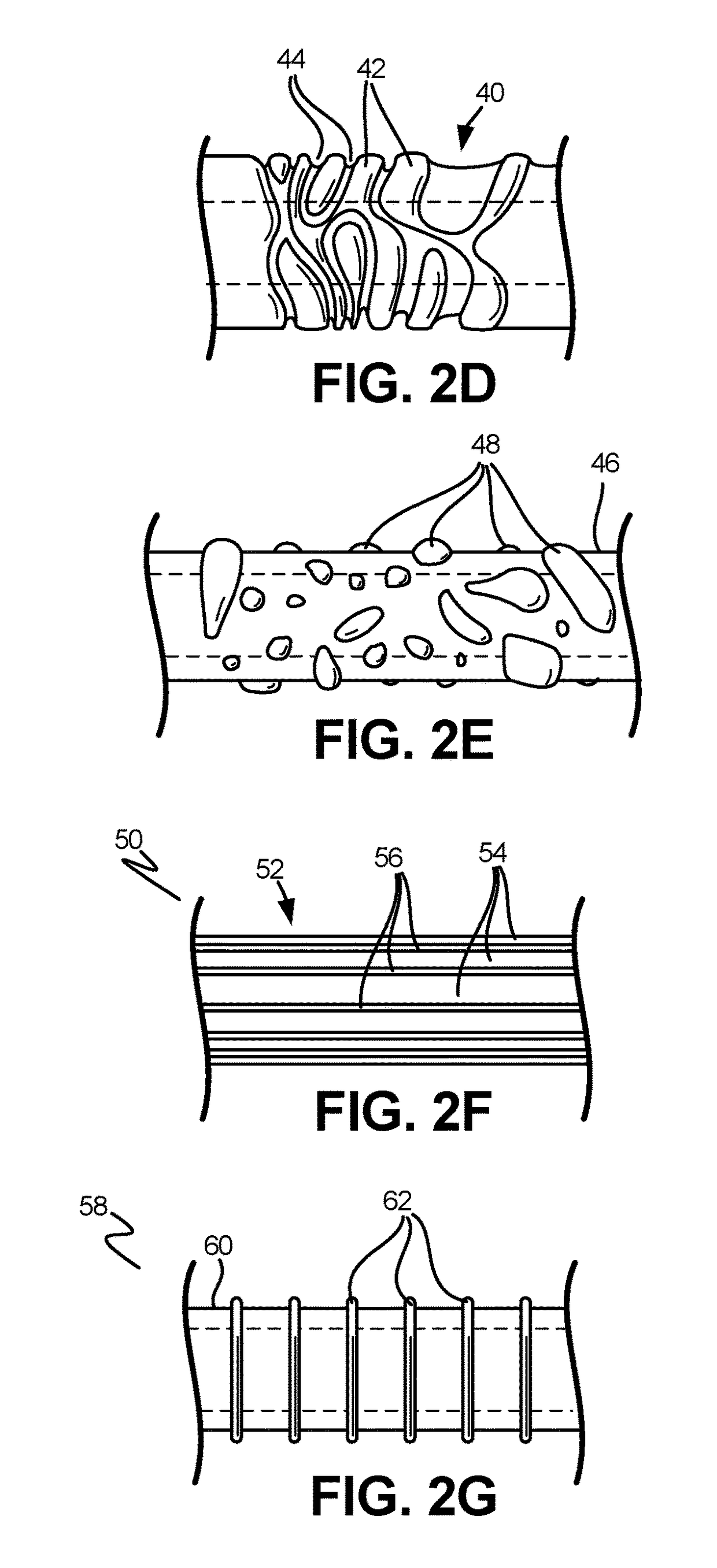 Catheter for Advancing Through a Vascular Stenosis and Related Methods