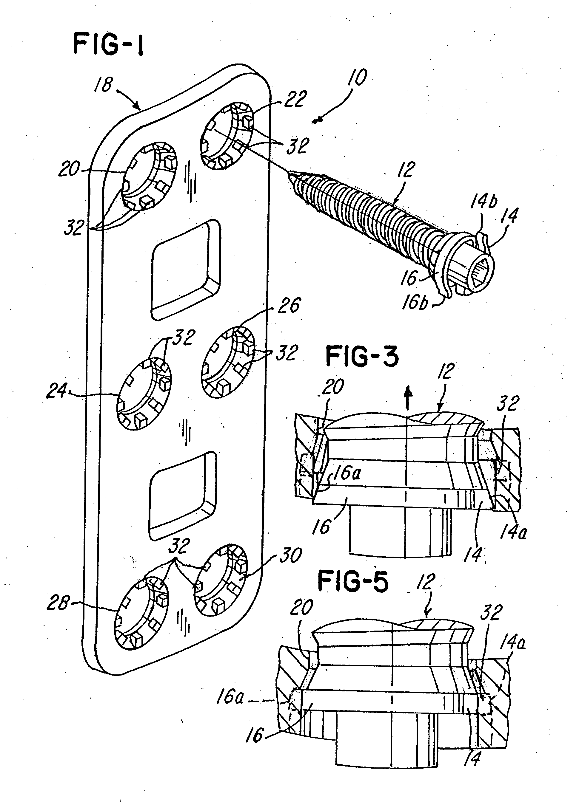 Implant plate screw locking system and screw having a locking member