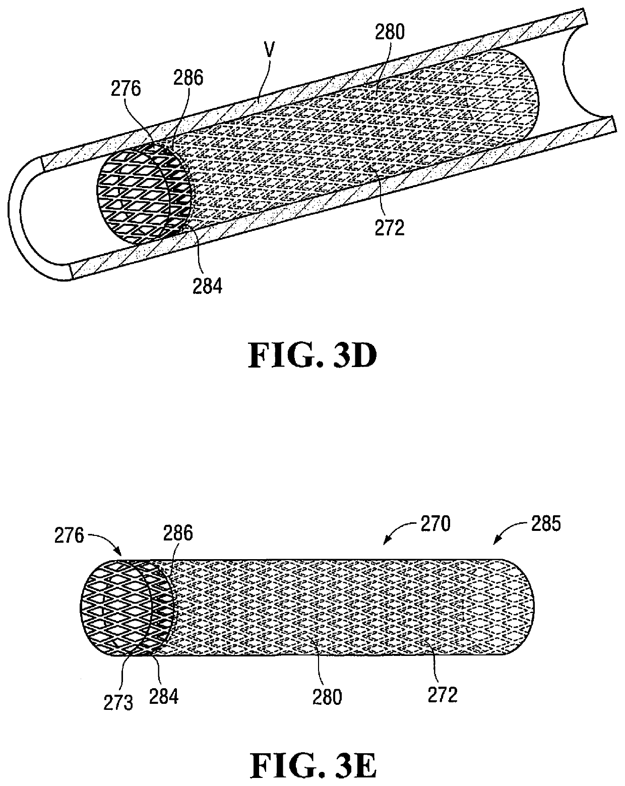 Caped stent