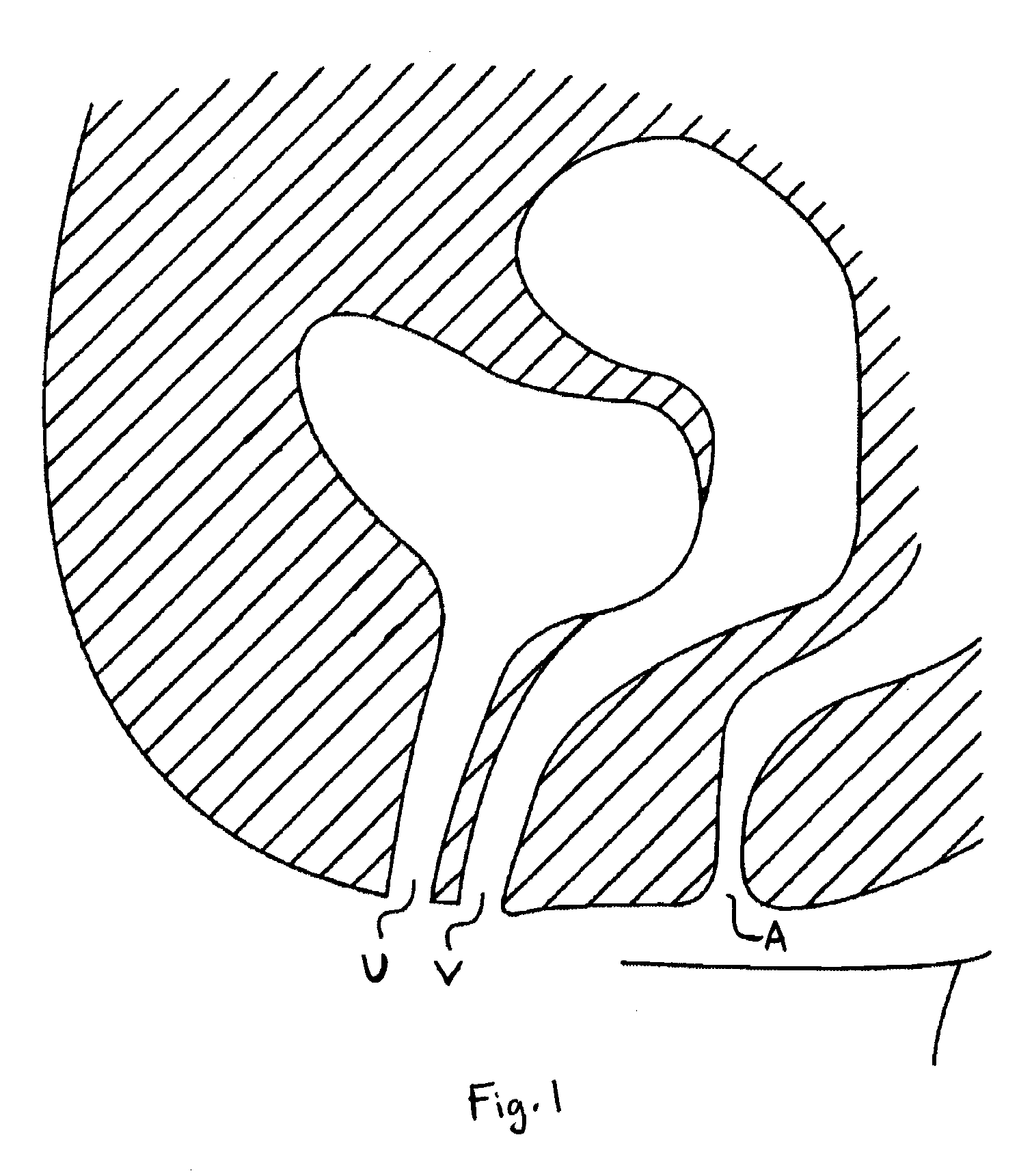 Elongate Implant System and Method for Treating Pelvic Conditions