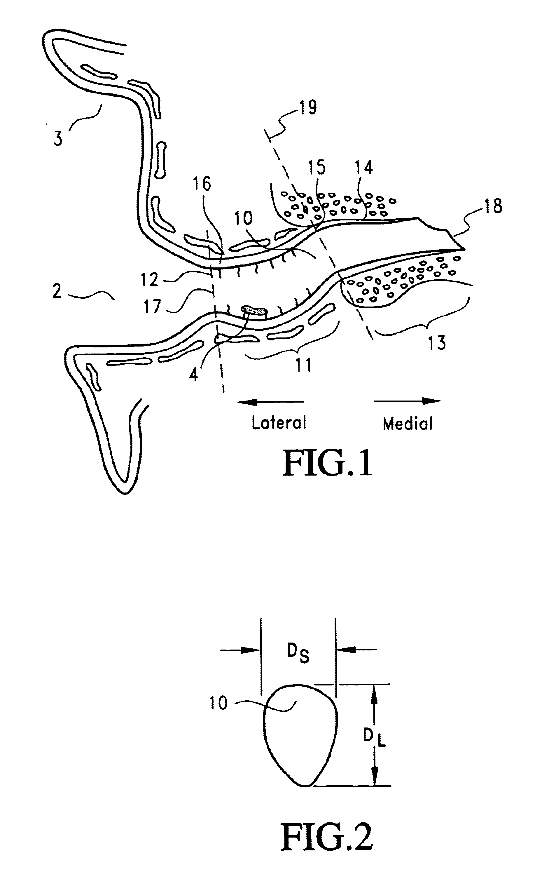Canal hearing device with tubular insert