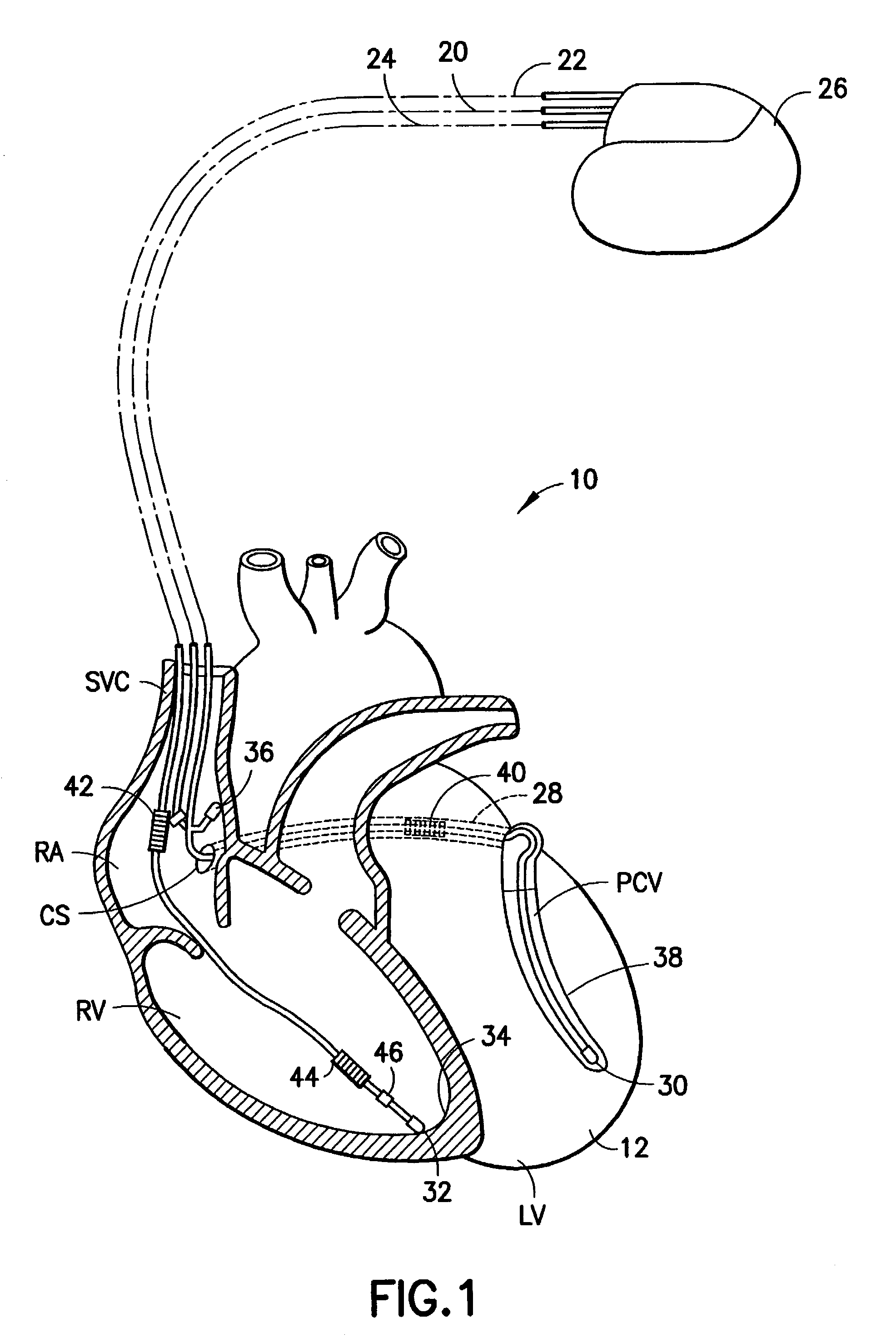 Stimulation/sensing electrodes for use with implantable cardiac leads in coronary vein locations
